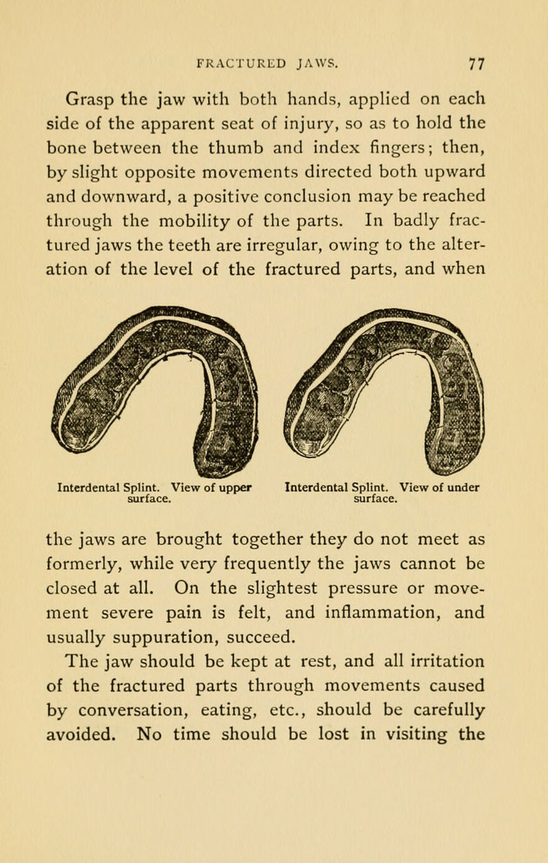 Grasp the jaw with both hands, applied on each side of the apparent seat of injury, so as to hold the bone between the thumb and index fingers; then, by slight opposite movements directed both upward and downward, a positive conclusion may be reached through the mobility of the parts. In badly frac- tured jaws the teeth are irregular, owing to the alter- ation of the level of the fractured parts, and when Interdental Splint. View of upper surface. Interdental Splint. View of under surface. the jaws are brought together they do not meet as formerly, while very frequently the jaws cannot be closed at all. On the slightest pressure or move- ment severe pain is felt, and inflammation, and usually suppuration, succeed. The jaw should be kept at rest, and all irritation of the fractured parts through movements caused by conversation, eating, etc., should be carefully avoided. No time should be lost in visiting the