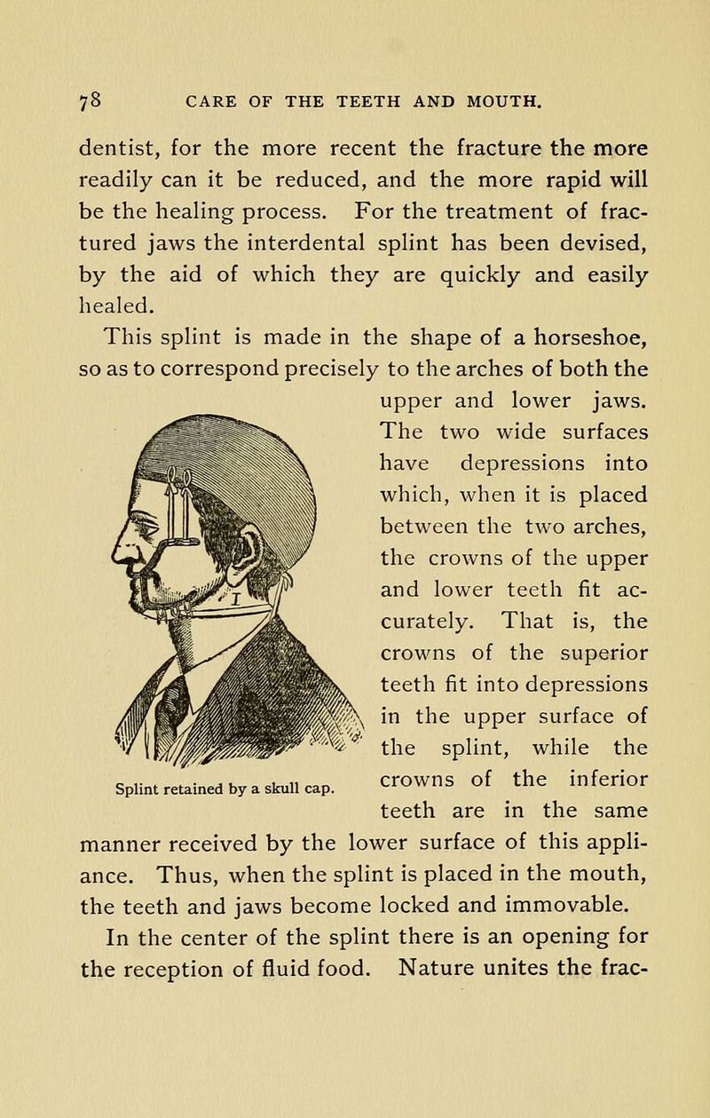 dentist, for the more recent the fracture the more readily can it be reduced, and the more rapid will be the healing process. For the treatment of frac- tured jaws the interdental splint has been devised, by the aid of which they are quickly and easily healed. This splint is made in the shape of a horseshoe, so as to correspond precisely to the arches of both the upper and lower jaws. The two wide surfaces have depressions into which, when it is placed between the two arches, the crowns of the upper and lower teeth fit ac- curately. That is, the crowns of the superior teeth fit into depressions in the upper surface of the splint, while the crowns of the inferior teeth are in the same manner received by the lower surface of this appli- ance. Thus, when the splint is placed in the mouth, the teeth and jaws become locked and immovable. In the center of the splint there is an opening for the reception of fluid food. Nature unites the frac- Splint retained by a skull cap.