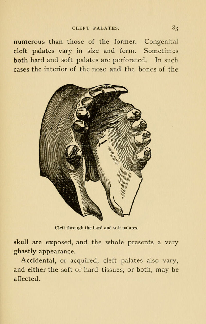 numerous than those of the former. Congenital cleft palates vary in size and form. Sometimes both hard and soft palates are perforated. In such cases the interior of the nose and the bones of the Cleft through the hard and soft palates. skull are exposed, and the whole presents a very- ghastly appearance. Accidental, or acquired, cleft palates also vary, and either the soft or hard tissues, or both, may be affected.