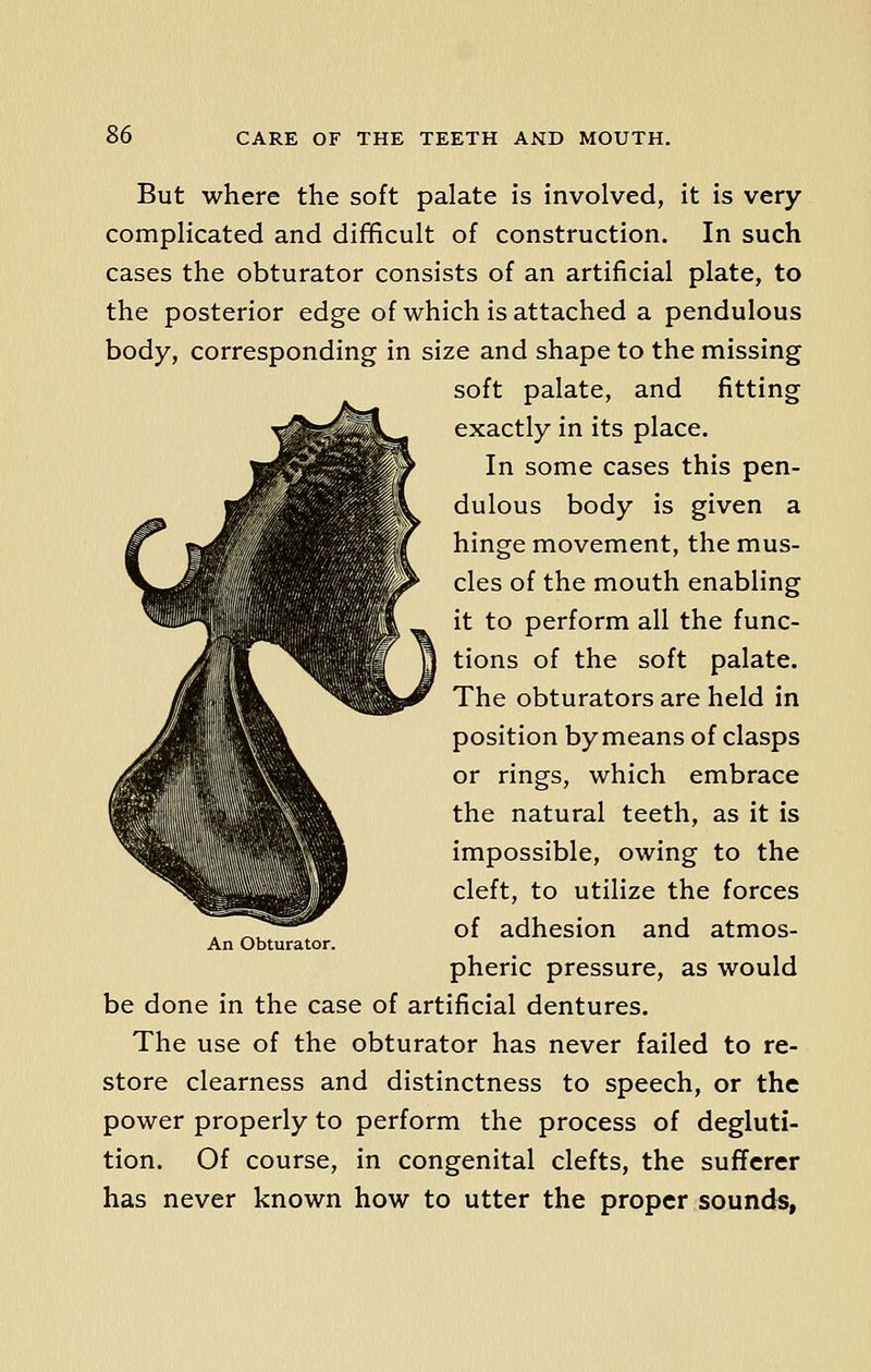 But where the soft palate is involved, it is very complicated and difficult of construction. In such cases the obturator consists of an artificial plate, to the posterior edge of which is attached a pendulous body, corresponding in size and shape to the missing soft palate, and fitting exactly in its place. In some cases this pen- dulous body is given a hinge movement, the mus- cles of the mouth enabling it to perform all the func- tions of the soft palate. The obturators are held in position by means of clasps or rings, which embrace the natural teeth, as it is impossible, owing to the cleft, to utilize the forces of adhesion and atmos- pheric pressure, as would be done in the case of artificial dentures. The use of the obturator has never failed to re- store clearness and distinctness to speech, or the power properly to perform the process of degluti- tion. Of course, in congenital clefts, the sufferer has never known how to utter the proper sounds, An Obturator.