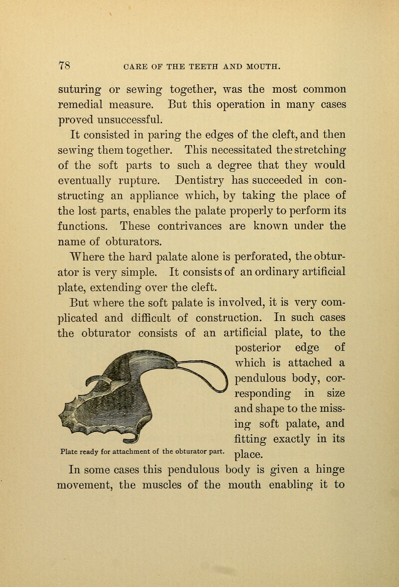 suturing or sewing together, was the most common remedial measure. But this operation in many cases proved unsuccessful. It consisted in paring the edges of the cleft, and then sewing them together. This necessitated the stretching of the soft parts to such a degree that they would eventually rupture. Dentistry has succeeded in con- structing an appliance which, by taking the place of the lost parts, enables the palate properly to perform its functions. These contrivances are known under the name of obturators. Where the hard palate alone is perforated, the obtur- ator is very simple. It consists of an ordinary artificial plate, extending over the cleft. But where the soft palate is involved, it is very com- plicated and diflBcult of construction. In such cases the obturator consists of an artificial plate, to the posterior edge of which is attached a pendulous body, cor- responding in size and shape to the miss- ing soft palate, and fitting exactly in its Plate ready for attachment of the obturator part, vjlopp In some cases this pendulous body is given a hinge movement, the muscles of the mouth enabling it to