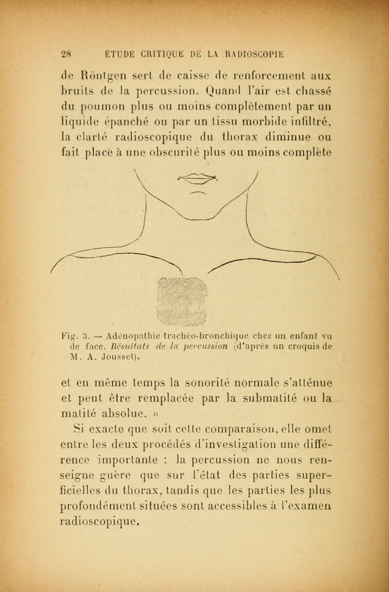 (If Hnntiicn sert do caisso do ronforccnienl aux bruits de la poiciissioii. ()iiaiid l'air est chassé du pou mou plus ou moins complèlemeiil par un liquide épanché ou par un tissu morbide iufdtré, la clarté radioscopique du thorax diminue ou fait placé îi une obscurité plus ou moins complète Fig. 3. — Adonopatliie trachéo-bronchique cliez un enfant vu (le face. BcstiHats de la percussion (d'après un croquis de M. A. Joussel). et en même temps la sonorité normale s'atténue et peut être remplacée par la submalité ou la malité absolue. » Si exacte que soit cotte comparaison, elle omet entre les deux procédés d'investigation une diffé- rence importante : la percussion ne nous ren- seigne guère que sur fétat des parties super- ficielles du thorax, tandis que les parties les plus profondément situées sont accessibles à l'examen radioscopique.
