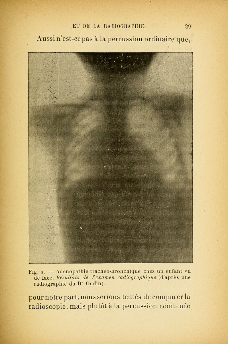 Aussi n'est-ce pas à la percussion ordinaire que, Fig. i. — Adeuopathie trachéo-broaciiique chez uu enfant vu de face. Résultais de l'examen radiographique (d'après une radiographie du Dr Oudin). pour noire part, nous serions tentés de comparer la radioscopie, mais plutôt à la percussion combinée