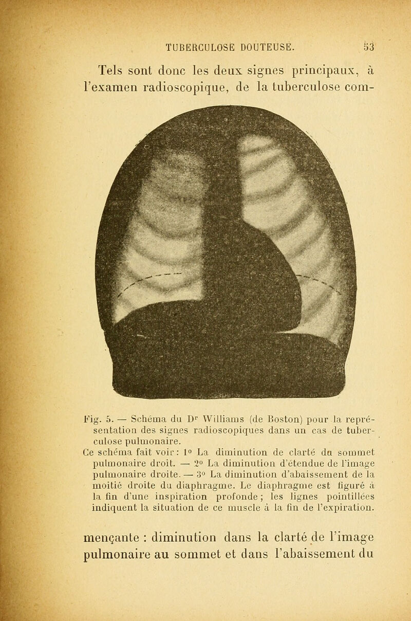 Tels sont donc les deux signes principaux, à l'examen radioscopique, de la tuberculose com- Fig. 6. — Schéma du D^ Williams (de Boston) pour la repré- sentation des signes radioscoplques dans un cas de tuber- culose pulmonaire. Ce schéma fait voir: 1° La diminution de clarté du sommet pulmonaire droit. — 2° La diminution d'étendue de l'image pulmonaire droite. — 3» La diminution d'abaissement de la moitié droite du diaphragme. Le diaphragme est figuré à la fin d'une inspiration profonde ; les lignes pointillées indiquent la situation de ce muscle à la fin de l'expiration. mençante : diminution dans la clarté de l'image pulmonaire au sommet et dans l'abaissement du