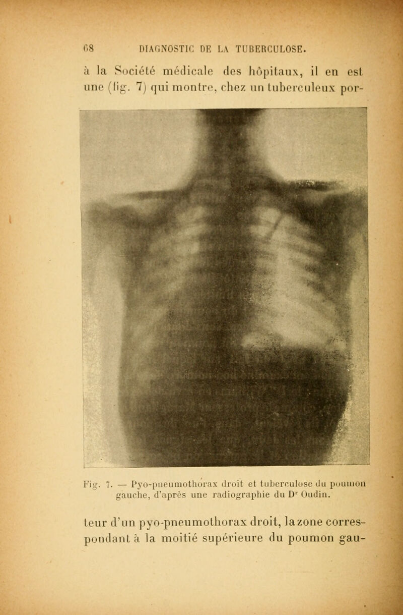 ;i la Société médicale des hôpitaux, il en est une (lig-. 7) qui monlrc, chez un tuberculeux por- Fii,'. 7. — i'yo-piieuiuollior.ix droit et tiiberrulose ilu pnumon gauche, d'après une radiographie du D' Oudin. teur d'un pyo-pneumothorax droit, lazone corres- pondant à la moitié supérieure du poumon gau-