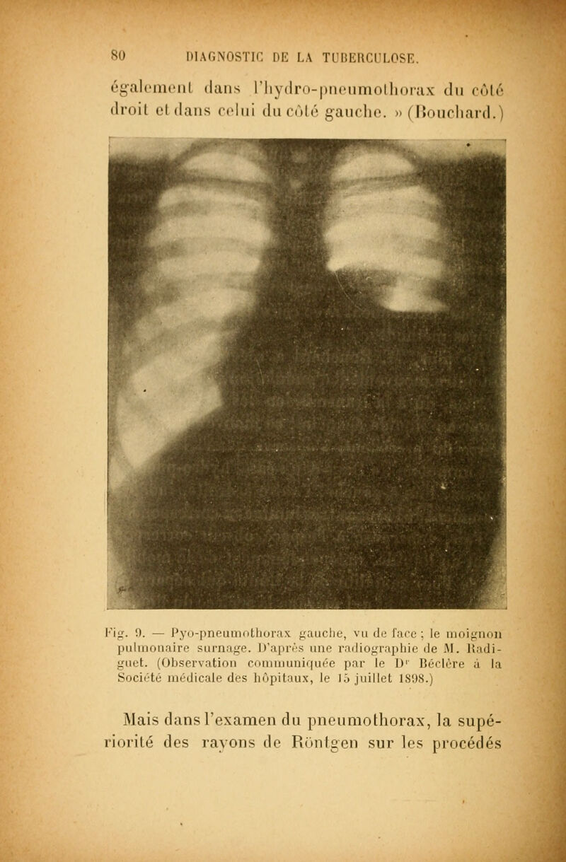 égalomonL dans riiydro-piicumollioiax du cùlé droit eldans colui du cùlé gauche. » (Boucliard.) Fig. !). — Py(i-i)neuiiiotliur.ix ^mucIic, vu de lacu : le inoigiion pulmonaire surnage. D'après une radiograpliio de M. Hadi- gact. (Observation cominunir|u(''C par le D' BéclL-re à la SociiHé médicale des hôpitaux, le l.j juillet 181)8.) Mais dans l'examen du pneumothorax, la supé- riorité des rayons de Rontgen sur les procédés