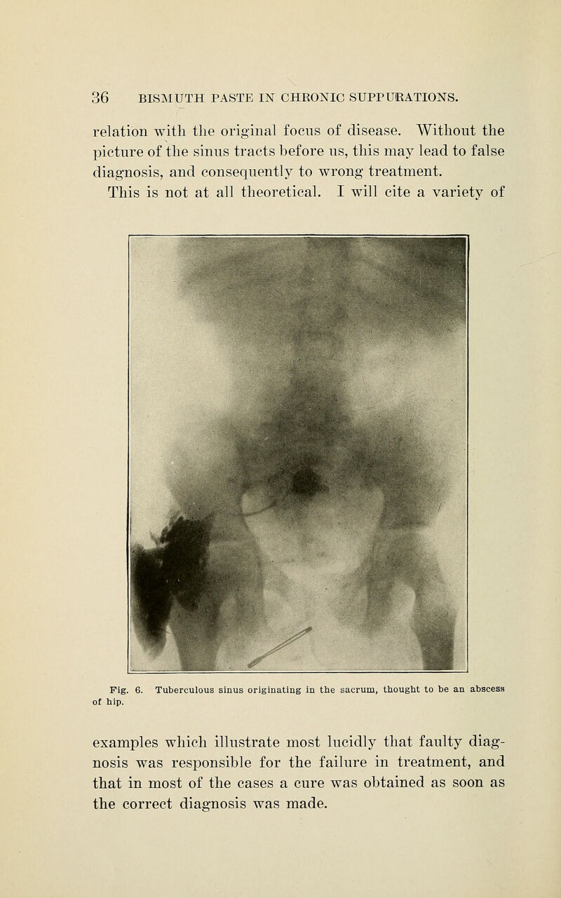 relation with the original focus of disease. Without the picture of the sinus tracts before us, this may lead to false diagnosis, and consequently to wrong treatment. This is not at all theoretical. I will cite a variety of Fig. 6. Tuberculous sinus originating in the sacrum, thought to be an abscess of hip. examples which illustrate most lucidly that faulty diag- nosis was responsible for the failure in treatment, and that in most of the cases a cure was obtained as soon as the correct diagnosis was made.