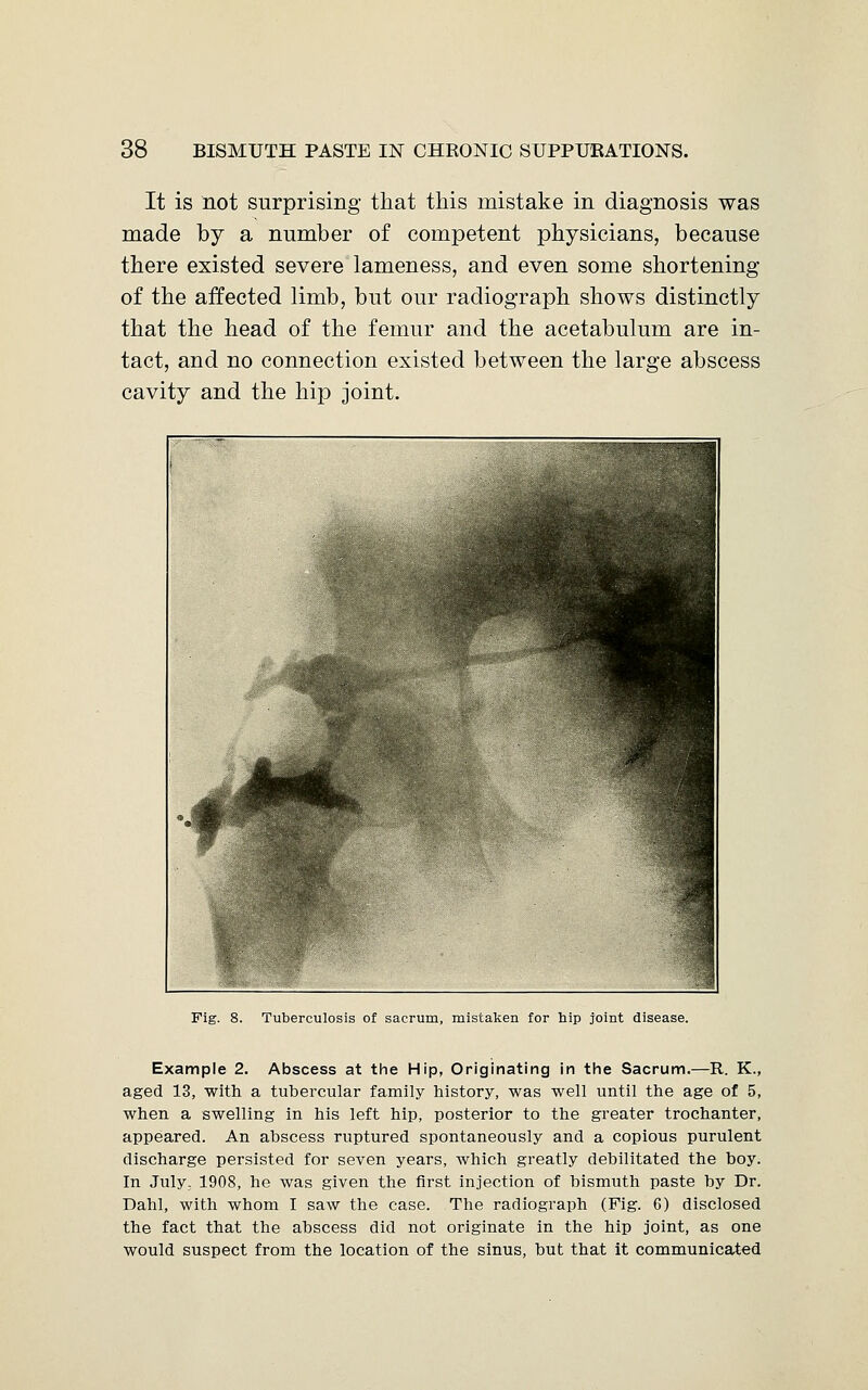 It is not surprising that this mistake in diagnosis was made by a number of competent physicians, because there existed severe lameness, and even some shortening of the affected limb, but our radiograph shows distinctly that the head of the femur and the acetabulum are in- tact, and no connection existed between the large abscess cavity and the hip joint. Fig. 8. Tuberculosis of sacrum, mistaken for hip joint disease. Example 2. Abscess at the Hip, Originating in the Sacrum.—R. K., aged 13, with a tubercular family history, was well until the age of 5, when a swelling in his left hip, posterior to the greater trochanter, appeared. An abscess ruptured spontaneously and a copious purulent discharge persisted for seven years, which greatly debilitated the boy. In July. 1908, he was given the first injection of bismuth paste by Dr. Dahl, with whom I saw the case. The radiograph (Fig. 6) disclosed the fact that the abscess did not originate in the hip joint, as one would suspect from the location of the sinus, but that it communicated