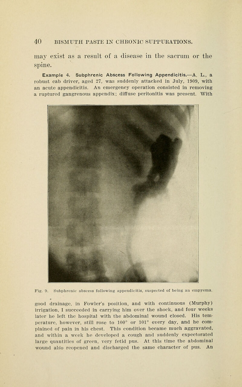 may exist as a result of a disease in the sacrum or the spine. Example 4. Subphrenic Abscess Following Appendicitis.—A. L., a robust cab driver, aged 27, was suddenly attacked in July, 1909, with an acute appendicitis. An emergency operation consisted in removing a ruptured gangrenous appendix; diffuse peritonitis was present. With Pig. 9. Subphrenic abscess following appendicitis, suspected of being an empyema. good drainage, in Fowler's position, and with continuous (Murphy) irrigation, I succeeded in carrying him over the shock, and four weeks later he left the hospital with the abdominal wound closed. His tem- perature, however, still rose to 100° or 101° every day, and he com- plained of pain in his chest. This condition became much aggravated, and within a week he developed a cough and suddenly expectorated large quantities of green, very fetid pus. At this time the abdominal wound also reopened and discharged the same character of pus. An