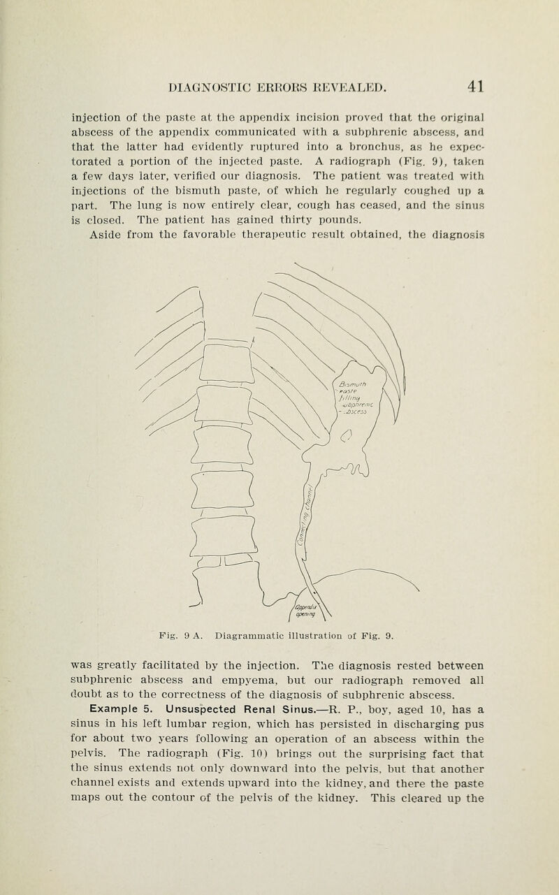 injection of the paste at the appendix incision proved that the original abscess of the appendix communicated with a subphrenic abscess, and that the latter had evidently ruptured into a bronchus, as he expec- torated a portion of the injected paste. A radiograph (Fig. 9), taken a few days later, verified our diagnosis. The patient was treated with injections of the bismuth paste, of which he regularly coughed up a part. The lung is now entirely clear, cough has ceased, and the sinus is closed. The patient has gained thirty pounds. Aside from the favorable therapeutic result obtained, the diagnosis / opening Fig. 9 A. Diagrammatic illustration of Fig. 9. was greatly facilitated by the injection. The diagnosis rested between subphrenic abscess and empyema, but our radiograph removed all doubt as to the correctness of the diagnosis of subphrenic abscess. Example 5. Unsuspected Renal Sinus.—R. P., boy, aged 10, has a sinus in his left lumbar region, which has persisted in discharging pus for about two years following an operation of an abscess within the pelvis. The radiograph (Fig. 10) brings out the surprising fact that the sinus extends not only downward into the pelvis, but that another channel exists and extends upward into the kidney, and there the paste maps out the contour of the pelvis of the kidney. This cleared up the