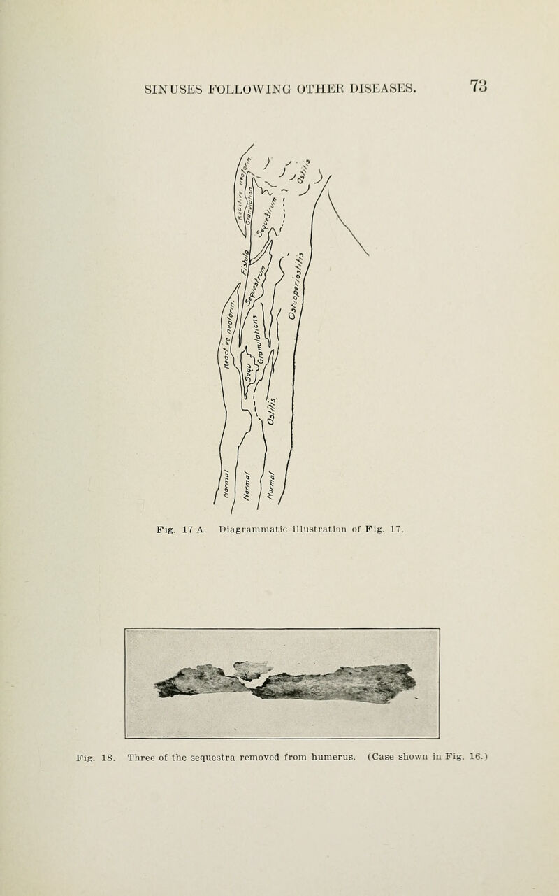 Fig. 17 A. Diagrammatic illustration of Fig. 17.