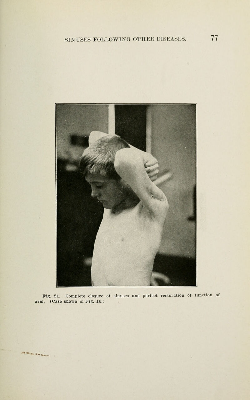 Fig. 21. Complete closure of sinuses and perfect restoration of function of arm. (Case shown in Fig. 16.)