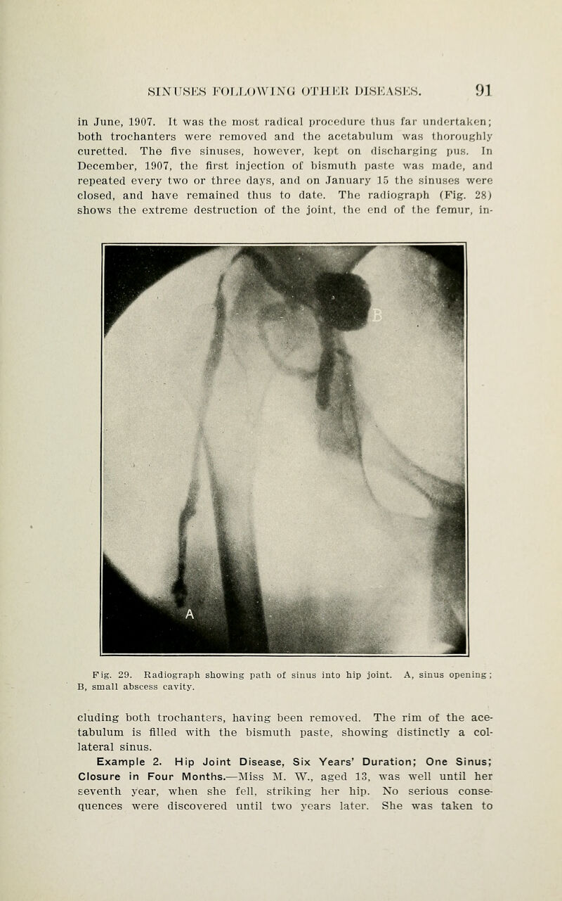 in June, 1907. It was the most radical procedure thus far undertaken; hoth trochanters were removed and the acetabulum was thoroughly curetted. The five sinuses, however, kept on discharging pus. In December, 1907, the first injection of bismuth paste was made, and repeated every two or three days, and on January 15 the sinuses were closed, and have remained thus to date. The radiograph (Fig. 28) shows the extreme destruction of the joint, the end of the femur, in- Fig. 29. Radiograph showing path of sinus into hip joint. B, small abscess cavity. A, sinus opening eluding both trochanters, having been removed. The rim of the ace- tabulum is filled with the bismuth paste, showing distinctly a col- lateral sinus. Example 2. Hip Joint Disease, Six Years' Duration; One Sinus; Closure in Four Months.—Miss M. W., aged 13, was well until her seventh year, when she fell, striking her hip. No serious conse- quences were discovered until two years later. She was taken to