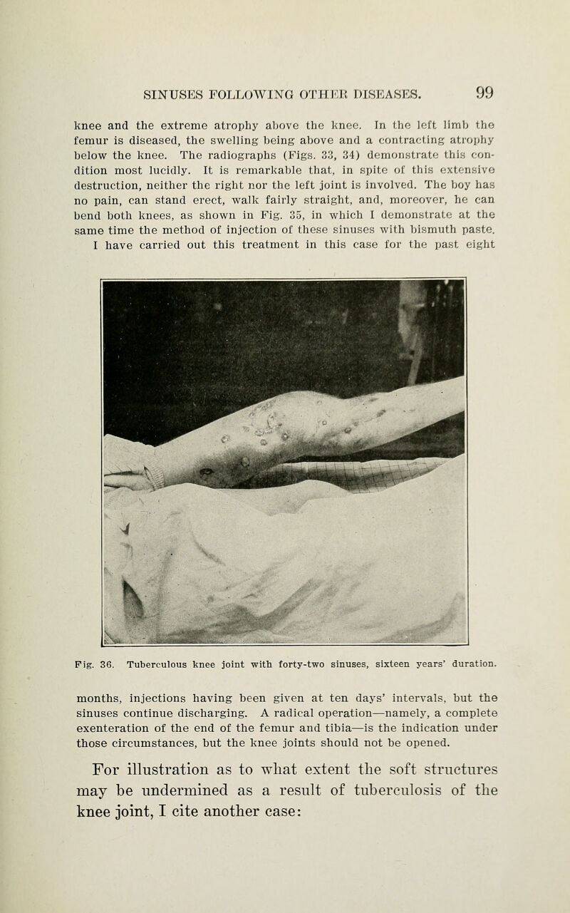 knee and the extreme atrophy above the knee. In the left limb the femur is diseased, the swelling being above and a contracting atrophy below the knee. The radiographs (Figs. 33, 34) demonstrate this con- dition most lucidly. It is remarkable that, in spite of this extensive destruction, neither the right nor the left joint is involved. The boy has no pain, can stand erect, walk fairly straight, and, moreover, he can bend both knees, as shown in Fig. 35, in which I demonstrate at the same time the method of injection of these sinuses with bismuth paste. I have carried out this treatment in this case for the past eight Fig. 36. Tuberculous knee joint with forty-two sinuses, sixteen years' duration. months, injections having been given at ten days' intervals, but the sinuses continue discharging. A radical operation—namely, a complete exenteration of the end of the femur and tibia—is the indication under those circumstances, but the knee joints should not be opened. For illustration as to what extent the soft structures may be undermined as a result of tuberculosis of the knee joint, I cite another case: