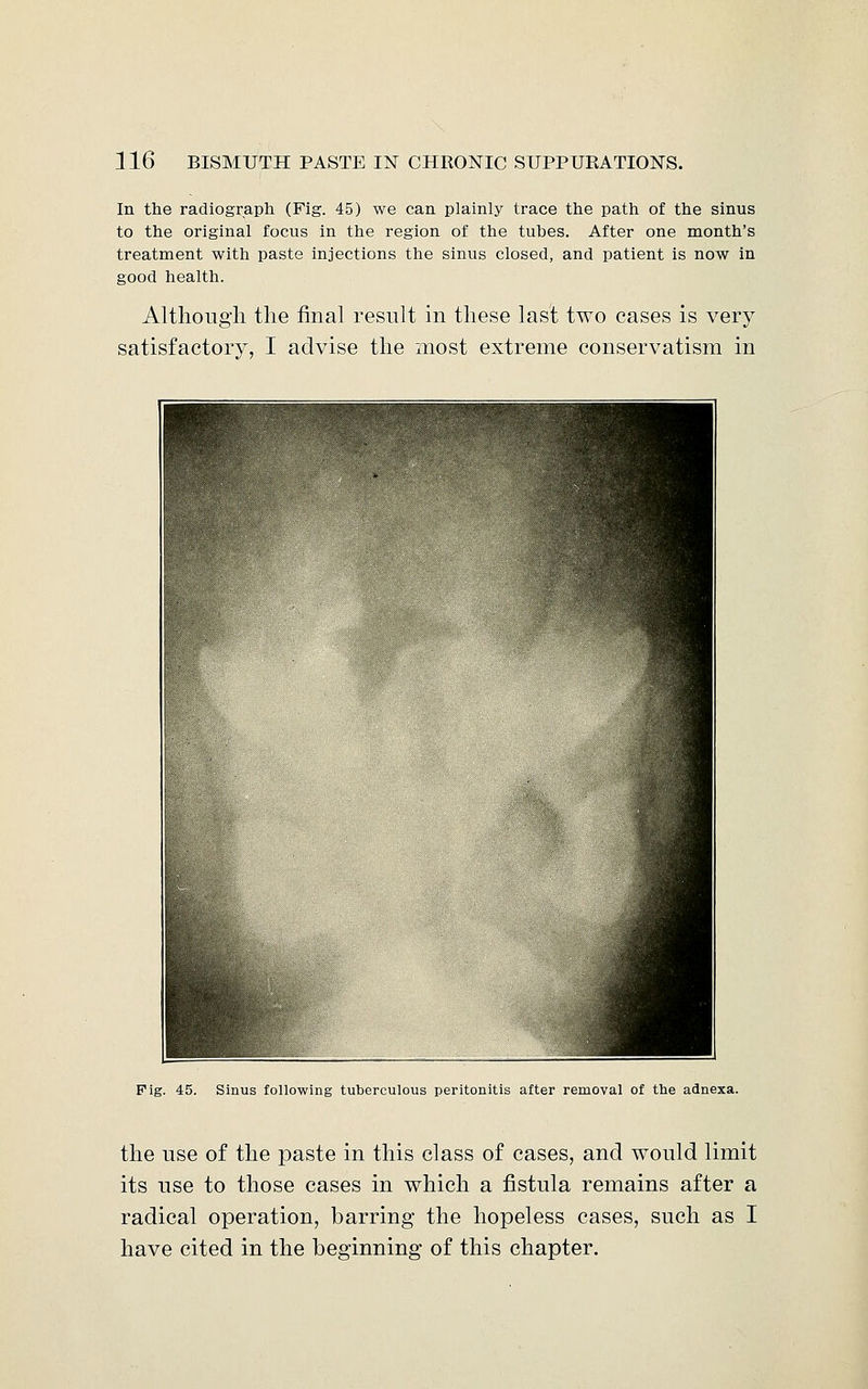 In the radiograph (Fig. 45) we can plainly trace the path of the sinus to the original focus in the region of the tubes. After one month's treatment with paste injections the sinus closed, and patient is now in good health. Although the final result in these last two cases is very satisfactory, I advise the most extreme conservatism in Pig. 45. Sinus following tuberculous peritonitis after removal of the adnexa. the use of the paste in this class of cases, and would limit its use to those cases in which a fistula remains after a radical operation, barring the hopeless cases, such as I have cited in the beginning of this chapter.