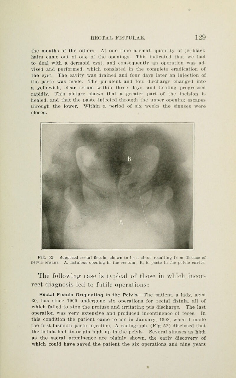 the mouths of the others. At one time a small quantity of jot-black hairs came out of one of the openings. This indicated that we had to deal with a dermoid cyst, and consequently an operation was ad- vised and performed, which consisted in the complete eradication of the cyst. The cavity was drained and four days later an injection of the paste was made. The purulent and foul discharge changed into a yellowish, clear serum within three days, and healing progressed rapidly. This picture shows that a greater part of the incision is healed, and that the paste injected through the upper opening escapes through the lower. Within a period of six weeks the sinuses were closed. Pig. 52. Supposed rectal fistula, shown to be a sinus resulting from disease of pelvic organs. A, fistulous opening in the rectum ; B, bi-paste in the pelvic cavity. The following case is typical of those in which incor- rect diagnosis led to futile operations: Rectal Fistula Originating in the Pelvis.—The patient, a lady, aged 30, has since 1900 undergone six operations for rectal fistula, all of which failed to stop the profuse and irritating pus discharge. The last operation was very extensive and produced incontinence of feces. In this condition the patient came to me in January. 1908. when I made the first bismuth paste injection. A radiograph (Fig. 52) disclosed that the fistula had its origin high up in the pelvis. Several sinuses as high as the sacral prominence are plainly shown, the early discovery of which could have saved the patient the six operations and nine years