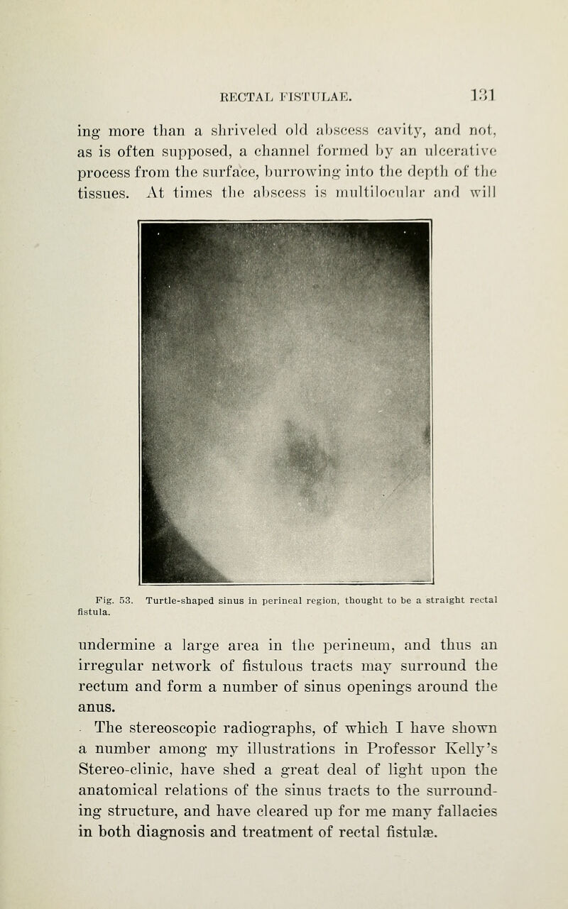 ing more than a shriveled old abscess cavity, and not, as is often supposed, a channel formed by an ulcerative process from the surface, burrowing into the depth of the tissues. At times the abscess is multilocular and will Fig. 53. Turtle-shaped sinus in perineal region, thought to be a straight rectal fistula. undermine a large area in the perineum, and thus an irregular network of fistulous tracts may surround the rectum and form a number of sinus openings around the anus. • The stereoscopic radiographs, of which I have shown a number among my illustrations in Professor Kelly's Stereo-clinic, have shed a great deal of light upon the anatomical relations of the sinus tracts to the surround- ing structure, and have cleared up for me many fallacies in both diagnosis and treatment of rectal fistulae.