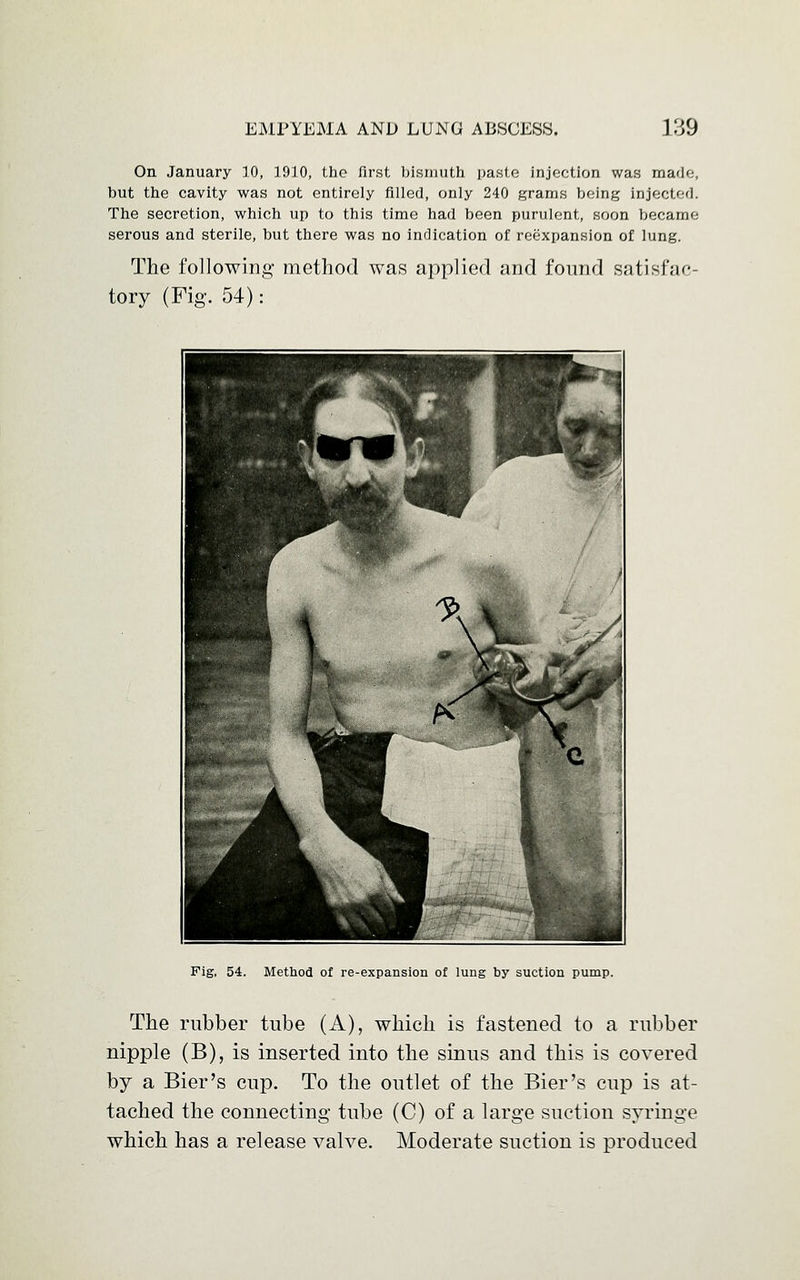 On January 10, 1910, the first bismuth paste injection was made, but the cavity was not entirely filled, only 240 grams being injected. The secretion, which up to this time had been purulent, soon became serous and sterile, but there was no indication of reexpansion of lung. The following method was applied and found satisfac- tory (Fig. 54): Fig, 54. Method of re-expansion of lung by suction pump. The rubber tube (A), which is fastened to a rubber nipple (B), is inserted into the sinus and this is covered by a Bier's cup. To the outlet of the Bier's cup is at- tached the connecting tube (C) of a large suction syringe which has a release valve. Moderate suction is produced