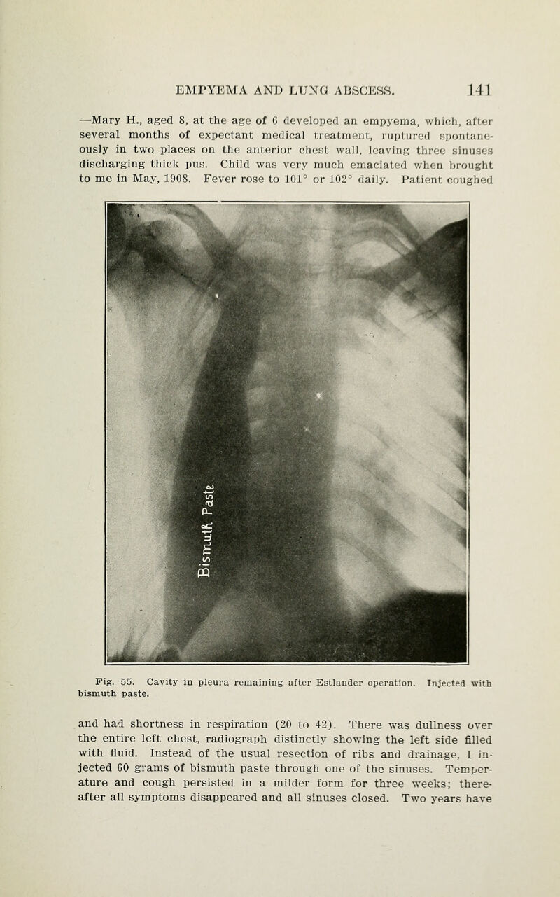 —Mary H., aged 8, at the age of 6 developed an empyema, which, after several months of expectant medical treatment, ruptured spontane- ously in two places on the anterior chest wall, leaving three sinui i discharging thick pus. Child was very much emaciated when brought to me in May, 1908. Fever rose to 101° or 102° daily. Patient, coughed Fig. 55. Cavity in pleura remaining after Estlander operation, bismuth paste. Injected with and had shortness in respiration (20 to 42). There was dullness over the entire left chest, radiograph distinctly showing the left side filled with fluid. Instead of the usual resection of ribs and drainage. I in- jected 60 grams of bismuth paste through one of the sinuses. Temper- ature and cough persisted in a milder form for three weeks; there- after all symptoms disappeared and all sinuses closed. Two years have