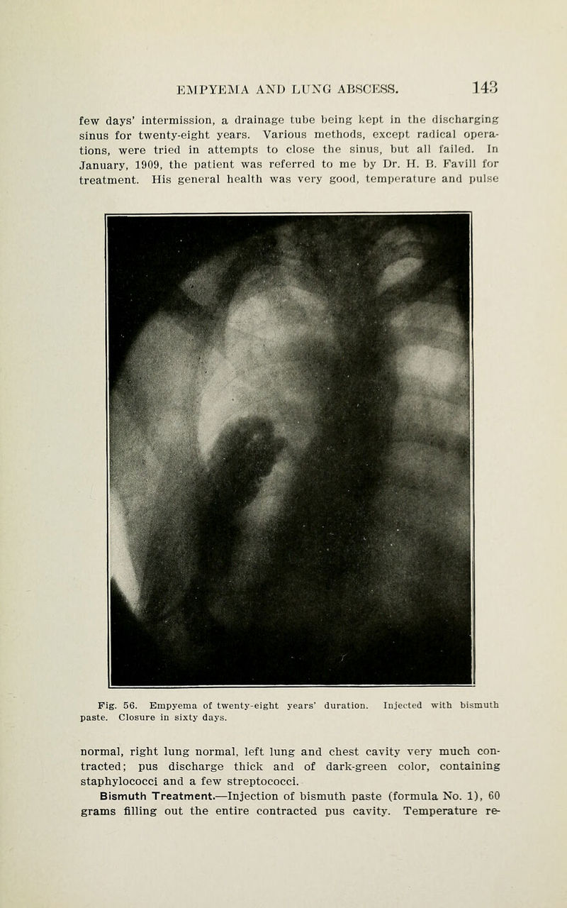 few days' intermission, a drainage tube being kept in the discharging sinus for twenty-eight years. Various methods, except radical opera- tions, were tried in attempts to close the sinus, but all failed. In January, 1909, the patient was referred to me by Dr. H. B. Favill for treatment. His general health was very good, temperature and pulse Pig. 56. Empyema of twenty-eight years' duration, paste. Closure in sixty days. Injected with bismuth normal, right lung normal, left lung and chest cavity very much con- tracted; pus discharge thick and of dark-green color, containing staphylococci and a few streptococci. Bismuth Treatment.—Injection of bismuth paste (formula No. 1), 60 grams filling out the entire contracted pus cavity. Temperature re-