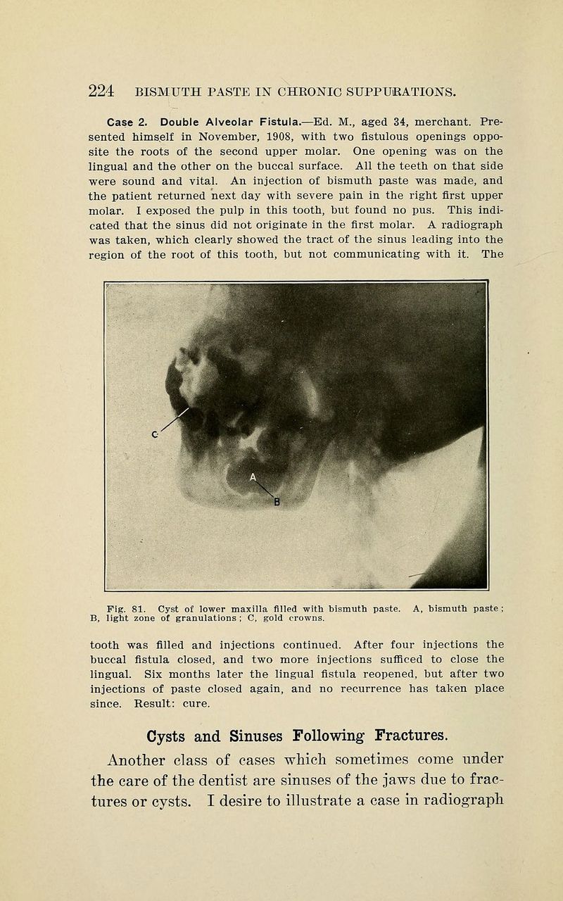 Case 2. Double Alveolar Fistula.—Ed. M., aged 34, merchant. Pre- sented himself in November, 1908, with two fistulous openings oppo- site the roots of the second upper molar. One opening was on the lingual and the other on the buccal surface. All the teeth on that side were sound and vital. An injection of bismuth paste was made, and the patient returned next day with severe pain in the right first upper molar. I exposed the pulp in this tooth, but found no pus. This indi- cated that the sinus did not originate in the first molar. A radiograph was taken, which clearly showed the tract of the sinus leading into the region of the root of this tooth, but not communicating with it. The Pig. 81. Cyst of lower maxilla filled with bismuth paste. A, bismuth paste ; B, light zone of granulations ; C, gold crowns. tooth was filled and injections continued. After four injections the buccal fistula closed, and two more injections sufficed to close the lingual. Six months later the lingual fistula reopened, but after two injections of paste closed again, and no recurrence has taken place since. Result: cure. Cysts and Sinuses Following Fractures. Another class of cases which sometimes come under the care of the dentist are sinnses of the jaws due to frac- tures or cysts. I desire to illustrate a case in radiograph