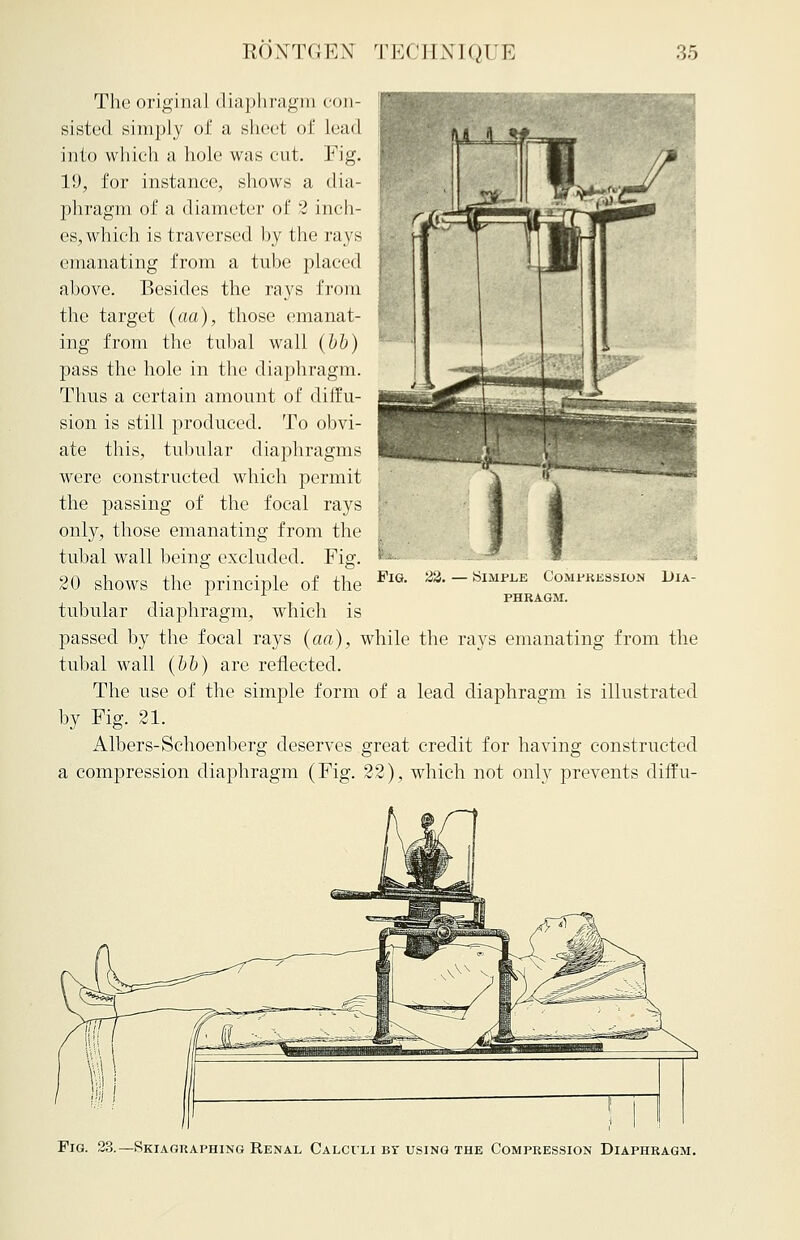 The original diaphragm con- sisted simply of a sheet of lead into which a hole was cut. Fig. 19, for instance, shows a dia- phragm of a diameter of 2 inch- es, which is traversed hy the rays emanating from a tube placed above. Besides the rays from the target (aa), those emanat- ing from the tubal wall (bb) pass the hole in the diaphragm. Thus a certain amount of diffu- sion is still produced. To obvi- ate this, tubular diaphragms were constructed which permit the passing of the focal rays only, those emanating from the tubal wall being excluded. Fig. 20 shows the principle of the tubular diaphragm, which is passed by the focal rays (aa), while the rays emanating from the tubal wall (bb) are reflected. The use of the simple form of a lead diaphragm is illustrated by Fig. 21. Albers-Schoenberg deserves great credit for having constructed a compression diaphragm (Fig. 22), which not only prevents diffu- FlG. 22. — Simple Compression Dia- phragm. Fig. 23.—Skiagraphing Renal Calculi bt using the Compression Diaphragm.