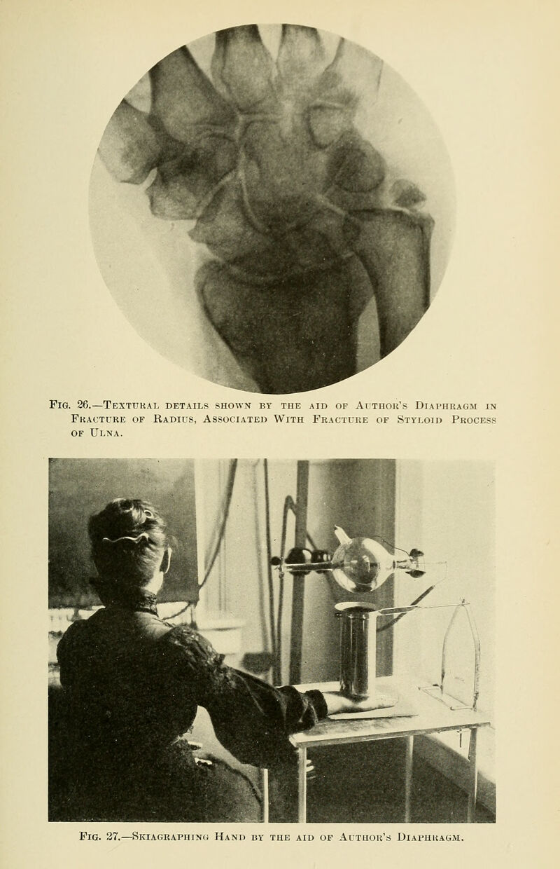 Fig. 26.—Textural details shown by the aid of Author's Diaphragm in Fracture of Radius, Associated With Fracture of Styloid Process of Ulna. Fig. 27.—Skiagraphing Hand by the aid of Author's Diaphragm.