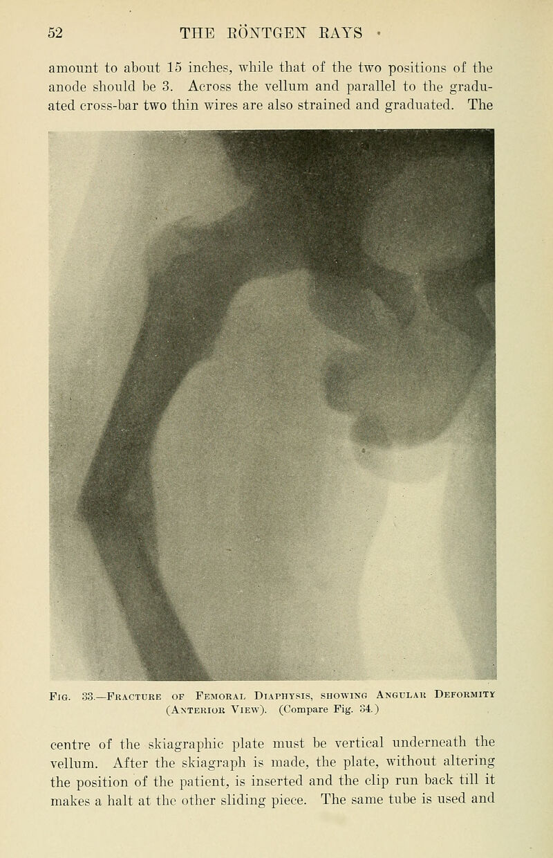 amount to about 15 inches, while that of the two positions of the anode should be 3. Across the vellum and parallel to the gradu- ated cross-bar two thin wires are also strained and graduated. The Fig. 33.—Fracture of Femoral Diapiiysis, showing Angular Deformity (Anterior View). (Compare Fig. 34) centre of the skiagraphic plate must be vertical underneath the vellum. After the skiagraph is made, the plate, without altering the position of the patient, is inserted and the clip run back till it makes a halt at the other sliding piece. The same tube is used and