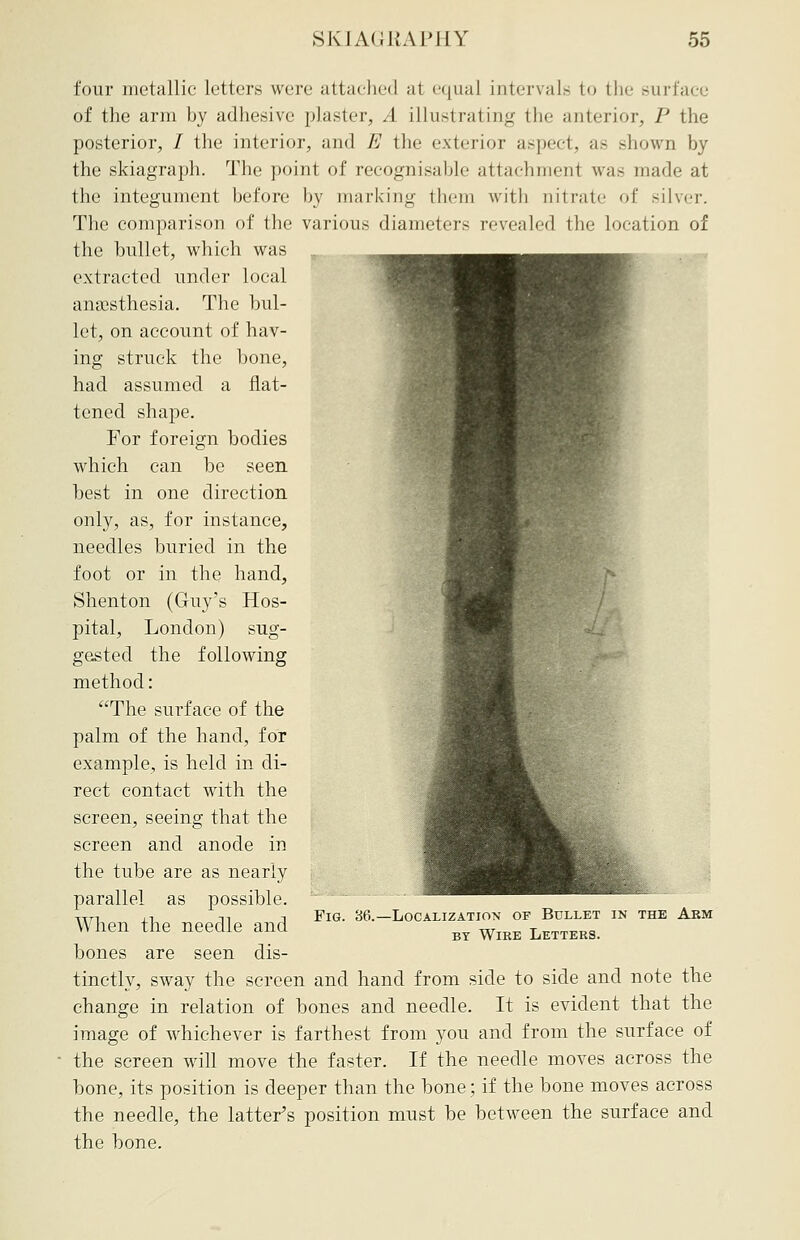 four metallic letters were attached at equal intervals to the surface of the arm by adhesive plaster, A illustrating the anterior, P the posterior, / the interior, and E the exterior aspect, as shown by the skiagraph. The point of recognisable attachmenl was made at the integument before by marking them with nil rate of silver. The comparison of the various diameters revealed the location of the bullet, which was extracted under local anaesthesia. The bul- let, on account of hav- ing struck the bone, had assumed a flat- tened shape. For foreign bodies which can be seen best in one direction only, as, for instance, needles buried in the foot or in the hand, Shenton (Guy's Hos- pital, London) sug- gested the following method: The surface of the palm of the hand, for example, is held in di- rect contact with the screen, seeing that the screen and anode in the tube are as nearly parallel as possible. When the needle and bones are seen dis- tinctly, sway the screen and hand from side to side and note the change in relation of bones and needle. It is evident that the image of whichever is farthest from you and from the surface of the screen will move the faster. If the needle moves across the bone, its position is deeper than the bone; if the bone moves across the needle, the latter's position must be between the surface and the bone. Fig. 36.—Localization of Bullet in the Arm by Wire Letters.