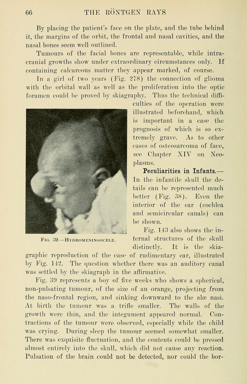 By placing the patient's face on the plate, and the tube behind it, the margins of the orbit, the frontal and nasal cavities, and the nasal bones seem well outlined. Tumours of the facial bones are representable, while intra- cranial growths show under extraordinary circumstances only. If containing calcareous matter they appear marked, of course. In a girl of two years (Fig. 278) the connection of glioma with the orbital wall as well as the proliferation into the optic foramen could be proved by skiagraphy. Thus the technical diffi- culties of the operation were illustrated beforehand, which is important in a case the prognosis of which is so ex- tremely grave. As to other eases of osteosarcoma of face, see Chapter XIV on Neo- plasms. Peculiarities in Infants.— In the infantile skull the de- tails can be represented much better (Fig. 38). Even the interior of the ear (cochlea and semicircular canals) can be shown. Fig. 143 also shows the in- ternal structures of the skull distinctly. It is the skia- graphic reproduction of the case of rudimentary ear, illustrated by Fig. 142. The question whether there was an auditory canal was settled by the skiagraph in the affirmative. Fig. 39 represents a boy of five weeks who shows a spherical, non-pulsating tumour, of the size of an orange, projecting from the naso-frontal region, and sinking downward to the alas nasi. At birth the tumour was a trifle smaller. The walls of the growth were thin, and the integument appeared normal. Con- tractions of the tumour were observed, especially while the child was crying. During sleep the tumour seemed somewhat smaller. There was exquisite fluctuation, and the contents could be pressed almost entirely into the skull, which did not cause any reaction. Pulsation of the brain could not be detected, nor could the bor- Fig. 39.—Hydromeningocele.