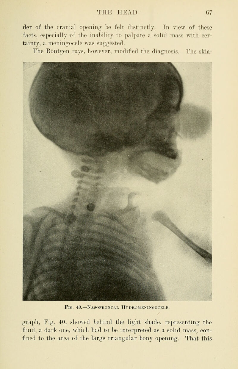 der of the cranial opening be felt distinctly. In view of these facts, especially of the inability to palpate a solid mass with cer- tainty, a meningocele was suggested. The Rontgen rays, however, modified the diagnosis. The skia- Fig. 40.—Nasofrontal Hydromeningocele. graph, Fig. 40, showed behind the light shade, representing the fluid, a dark one, which had to be interpreted as a solid mass, con- fined to the area of the large triangular bony opening. That this