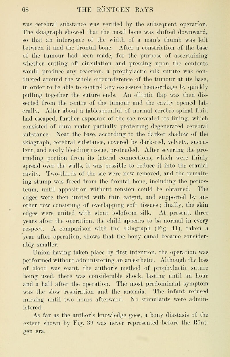 was cerebral substance was verified by tbe subsequent operation. The skiagraph showed that the nasal bone was shifted downward, so that an interspace of the width of a man's thumb was left between it and the frontal bone. After a constriction of the base of the tumour had been made, for the purpose of ascertaining whether cutting off circulation and pressing upon the contents would produce any reaction, a prophylactic silk suture was con- ducted around the whole circumference of the tumour at its base, in order to be able to control any excessive haemorrhage by quickly pulling together the suture ends. An elliptic flap was then dis- sected from the centre of the tumour and the cavity opened lat- erally. After about a tablespoonful of normal cerebro-spinal fluid had escaped, further exposure of the sac revealed its lining, which consisted of dura mater partially protecting degenerated cerebral substance. Near the base, according to the darker shadow of the skiagraph, cerebral substance, covered by dark-red, velvety, succu- lent, and easily bleeding tissue, protruded. After severing the pro- truding portion from its lateral connections, which were thinly spread over the walls, it was possible to reduce it into the cranial cavity. Two-thirds of the sac were now removed, and the remain- ing stump was freed from the frontal bone, including the perios- teum, until apposition without tension could be obtained. The edges were then united with thin catgut, and supported by an- other row consisting of overlapping soft tissues; finally, the skin edges were united with stout iodoform silk. At present, three years after the operation, the child appears to be normal in every respect. A comparison with the skiagraph (Fig. 41), taken a year after operation, shows that the bony canal became consider- ably smaller. Union having taken place by first intention, the operation was performed without administering an anaesthetic. Although the loss of blood was scant, the author's method of prophylactic suture being used, there was considerable shock, lasting until an hour and a half after the operation. The most predominant symptom was the slow respiration and the anaemia. The infant refused nursing until two hours afterward. No stimulants were admin- istered. . As far as the author's knowledge goes, a bony diastasis of the extent shown by Fig. 39 was never represented before the Ront- gen era.