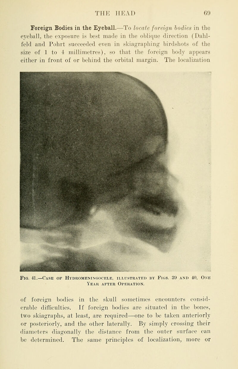 Foreign Bodies in the Eyeball.—To locate foreign bodies in the eyeball, the exposure is best made in the oblique direction (Dahl- feld and Pohrt succeeded even in skiagraphing birdshote of the size of 1 to 4 millimetres), so that the foreign body appears either in front of or behind the orbital margin. The localization Fig. 41.—Case of Hydromeningocele, illustrated by Figs. 39 and 40, One Yeak after Operation. of foreign bodies in the skull sometimes encounters consid- erable difficulties. If foreign bodies are situated in the bones, two skiagraphs, at least, are required—one to be taken anteriorly or posteriorly, and the other laterally. By simply crossing their diameters diagonally the distance from the outer surface can be determined. The same principles of localization, more or