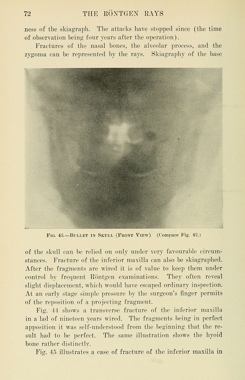 ness of the skiagraph. The attacks have stopped since (the time of observation being four years after the operation). Fractures of the nasal bones, the alveolar process, and the zygoma can be represented by the rays. Skiagraphy of the base Fig. 43.—Bullet in Skull (Front View). (Compare Fig. 42.) of the skull can be relied on only under very favourable circum- stances. Fracture of the inferior maxilla can also be skiagraphed. After the fragments are wired it is of value to keep them under control by frequent Bontgen examinations. They often reveal slight displacement, which would have escaped ordinary inspection. At an early stage simple pressure by the surgeon's finger permits of the reposition of a projecting fragment. Fig. 44 shows a transverse fracture of the inferior maxilla in a lad of nineteen years wired. The fragments being in perfect apposition it was self-understood from the beginning that the re- sult had to be perfect. The same illustration shows the hyoid bone rather distinctly. Fig. 45 illustrates a case of fracture of the inferior maxilla in