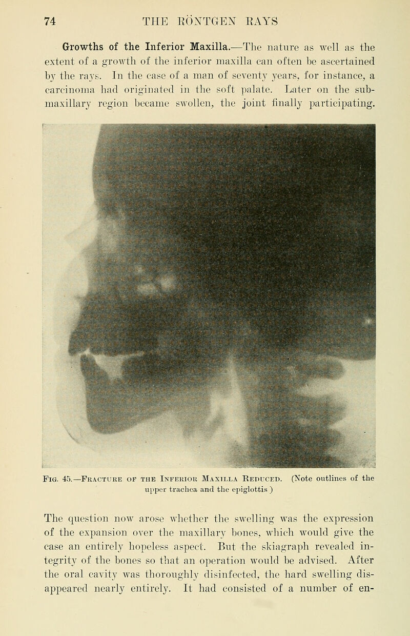 Growths of the Inferior Maxilla.—The nature as well as the extent of a growth of the inferior maxilla can often be ascertained by the rays. In the case of a man of seventy years, for instance, a carcinoma had originated in the soft palate. Later on the sub- maxillary region became swollen, the joint finally participating. Pig. 45.—Fracture of the Inferior Maxilla Reduced. (Note outlines of the upper trachea and the epiglottis ) The question now arose whether the swelling was the expression of the expansion over the maxillary bones, which would give the case an entirely hopeless aspect. But the skiagraph revealed in- tegrity of the bones so that an operation would be advised. After the oral cavity was thoroughly disinfected, the hard swelling dis- appeared nearly entirely. It had consisted of a number of en-