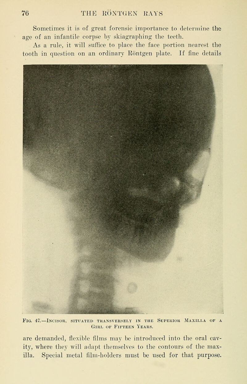 Sometimes it is of great forensic importance to determine the age of an infantile corpse by skiagraphing the teeth. As a rule, it will suffice to place the face portion nearest the tooth in question on an ordinary Eontgen plate. If fine details Fig. 47.—Incisor, situated transversely in the Superior Maxilla of a Girl of Fifteen Years. are demanded, flexible films may be introduced into the oral cav- ity, where they will adapt themselves to the contours of the max- illa. Special metal film-holders must be used for that purpose.