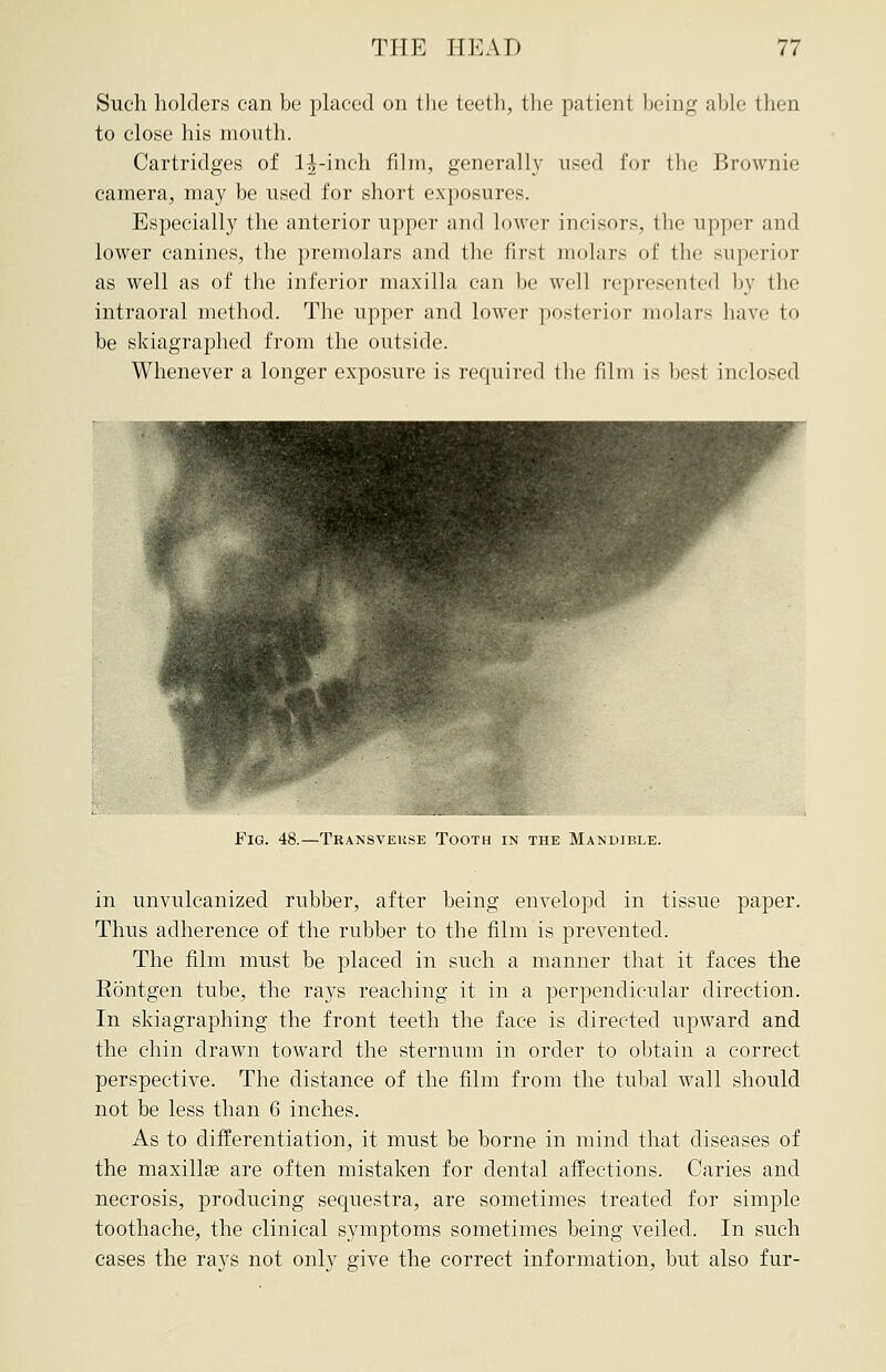 Such holders can be placed on the teeth, the patient being able then to close his mouth. Cartridges of H-inch film, generally used for the Brownie camera, may be used for short exposures. Especially the anterior upper and Lower incisors, tbe upper and lower canines, the premolars and the first molars of the superior as well as of the inferior maxilla can be well represented by the intraoral method. The upper and lower posterior molars have to be skiagraphed from the outside. Whenever a longer exposure is required the film is best inclosed Fig. 48.—Transvekse Tooth in the Mandible. in unvulcanized rubber, after being envelopd in tissue paper. Thus adherence of the rubber to the film is prevented. The film must be placed in such a manner that it faces the Eontgen tube, the rays reaching it in a perpendicular direction. In skiagraphing the front teeth the face is directed upward and the chin drawn toward the sternum in order to obtain a correct perspective. The distance of the film from the tubal wall should not be less than 6 inches. As to differentiation, it must be borne in mind that diseases of the maxillae are often mistaken for dental affections. Caries and necrosis, producing sequestra, are sometimes treated for simple toothache, the clinical symptoms sometimes being veiled. In such cases the rays not only give the correct information, but also fur-