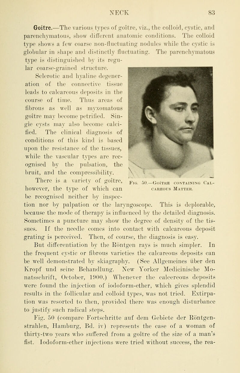 Goitre.—The various types of goil re, viz., the colloid, cystic, and parenchymatous, show different anatomic conditions. The colloid type shows a few coarse non-fluctuating nodules while the cystic is globular in shape and distinctly fluctuating. The parenchymatous type is distinguished by its regu- lar coarse-grained structure. Sclerotic and hyaline degener- ation of the connective tissue leads to calcareous deposits in the course of time. Thus areas of fibrous as well as myxomatous goitre may become petrified. Sin- gle cysts may also become calci- fied. The clinical diagnosis of conditions of this kind is based upon the resistance of the tissues, while the vascular types are rec- ognised by the pulsation, the bruit, and the compressibility. There is a variety of goitre, however, the type of which can be recognised neither by inspec- tion nor by palpation or the laryngoscope. This is deplorable, because the mode of therapy is influenced by the detailed diagnosis. Sometimes a puncture may show the degree of density of the tis- sues. If the needle comes into contact with calcareous deposit grating is perceived. Then, of course, the diagnosis is easy. But differentiation by the Eontgen rays is much simpler. In the frequent cystic or fibrous varieties the calcareous deposits can be well demonstrated by skiagraphy. (See Allgemeines fiber den Kropf und seine Behandlung. New Yorker Medicinische Mo- natsschrift, October, 1900.) Whenever the calcereous deposits were found the injection of iodoform-ether, which gives splendid results in the follicular and colloid types, was not tried. Extirpa- tion was resorted to then, provided there was enough disturbance to justify such radical steps. Fig. 50 (compare Fortsehritte auf dem Gebiete der Rontgen- strahlen, Hamburg, Bd. iv) represents the case of a woman of thirty-two years who suffered from a goitre of the size of a man's fist. Iodoform-ether injections were tried without success, the rea- Fig. ;j0. -GoiTKE CONTAINING CAL- CAREOUS Matter.