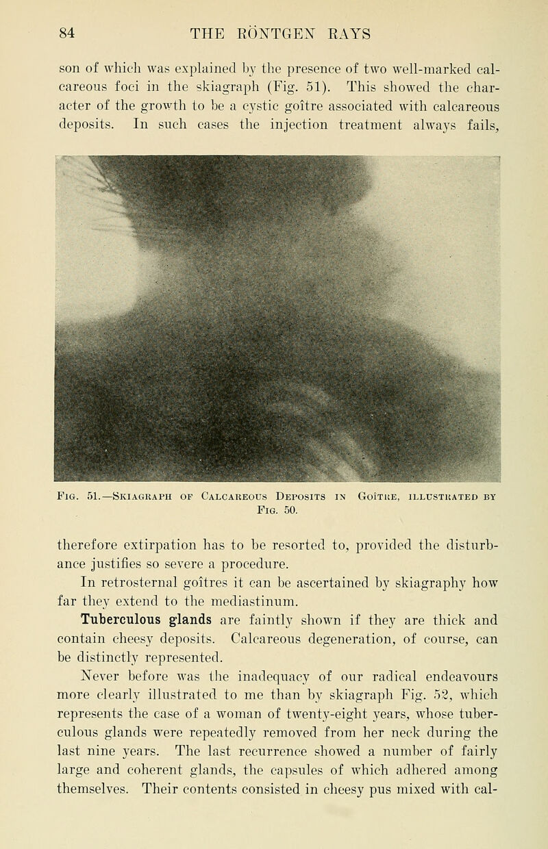 son of which was explained by the presence of two well-marked cal- careous foci in the skiagraph (Fig. 51). This showed the char- acter of the growth to be a cystic goitre associated with calcareous deposits. In such cases the injection treatment always fails, Fig. 51.—Skiagraph of Calcareous Deposits in Goitre, illustrated by Fig. 50. therefore extirpation has to be resorted to, provided the disturb- ance justifies so severe a procedure. In retrosternal goitres it can be ascertained by skiagraphy how far they extend to the mediastinum. Tuberculous glands are faintly shown if they are thick and contain cheesy deposits. Calcareous degeneration, of course, can be distinctly represented. Never before was the inadequacy of our radical endeavours more clearly illustrated to me than by skiagraph Fig. 52, which represents the case of a woman of twenty-eight years, whose tuber- culous glands were repeatedly removed from her neck during the last nine years. The last recurrence showed a number of fairly large and coherent glands, the capsules of which adhered among themselves. Their contents consisted in cheesy pus mixed with cal-