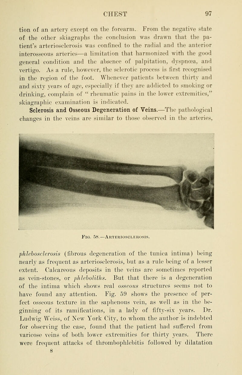 tion of an artery except on the forearm. From the negative state of the other skiagraphs the conclusion was drawn that the pa- tient's arteriosclerosis was confined to the radial and the anterior interosseous arteries—a limitation that harmonized with the good general condition and the absence of palpitation, dyspnoea, and vertigo. As a rule, however, the sclerotic process is first recognised in the region of the foot. Whenever patients between thirty and and sixty years of age, especially if they are addicted to smoking or drinking, complain of  rheumatic pains in the lower extremities, skiagraphic examination is indicated. Sclerosis and Osseous Degeneration of Veins.—The pathological changes in the veins are similar to those observed in the arteries, Fig. 58.—Arteriosclerosis. phlebosderosis (fibrous degeneration of the tunica intima) being nearly as frequent as arteriosclerosis, but as a rule being of a lesser extent. Calcareous deposits in the veins are sometimes reported as vein-stones, or phleboliths. But that there is a degeneration of the intima which shows real osseous structures seems not to have found any attention. Fig. 59 shows the presence of per- fect osseous texture in the saphenous vein, as well as in the be- ginning of its ramifications, in a lady of fifty-six years. Dr. Ludwig Weiss, of New York City, to whom the author is indebted for observing the case, found that the patient had suffered from varicose veins of both lower extremities for thirty years. There were frequent attacks of thrombophlebitis followed by dilatation