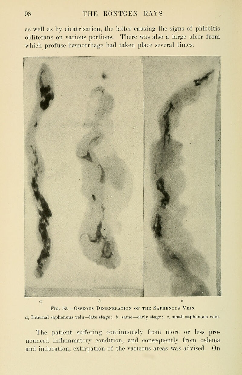 as well as by cicatrization, the latter causing the signs of phlebitis obliterans on various portions. There was also a large ulcer from which profuse hemorrhage had taken place several times. Fig. 59.—Osseous Degeneration of the Saphenous Vein. «, Internal saphenous vein—late stage; b, same—early stage; c, small saphenous vein. The patient suffering continuously from more or less pro- nounced inflammatory condition, and consequently from oedema and induration, extirpation of the varicous areas was advised. On