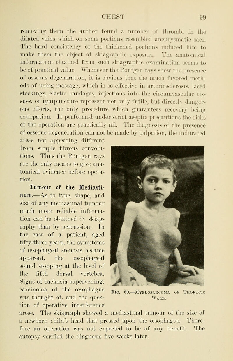 removing them the author found a number of thrombi in the dilated veins which on some portions resembled aneurysmatic sacs. The hard consistency of the thickened portions induced him to make them the object of skiagraphic exposure. The anatomical information obtained from such skiagraphic examination seems to be of practical value. Whenever the Rontgen rays show the presence of osseous degeneration, it is obvious that the much favored meth- ods of using massage, which is so effective in arteriosclerosis, laced stockings, elastic bandages, injections into the circumvascular tis- sues, or ignipuncture represent not only futile, but directly danger- ous efforts, the only procedure which guarantees recovery being extirpation. If performed under strict aseptic precautions the risks of the operation are practically nil. The diagnosis of the presence of osseous degeneration can not be made by palpation, the indurated areas not appearing different from simple fibrous convolu- tions. Thus the Rontgen rays are the only means to give ana- tomical evidence before opera- tion. Tumour of the Mediasti- num.—As to type, shape, and size of any mediastinal tumour much more reliable informa- tion can be obtained by skiag- raphy than by percussion. In the case of a patient, aged fifty-three years, the symptoms of oesophageal stenosis became apparent, the oesophageal sound stopping at the level of the fifth dorsal vertebra. Signs of cachexia supervening, carcinoma of the oesophagus was thought of, and the ques- tion of operative interference arose. The skiagraph showed a mediastinal tumour of the size of a newborn child's head that pressed upon the oesophagus. There- fore an operation was not expected to be of any benefit. The autopsy verified the diagnosis five weeks later. Fig. 60.—Myelosarcoma of Thoracic Wall.
