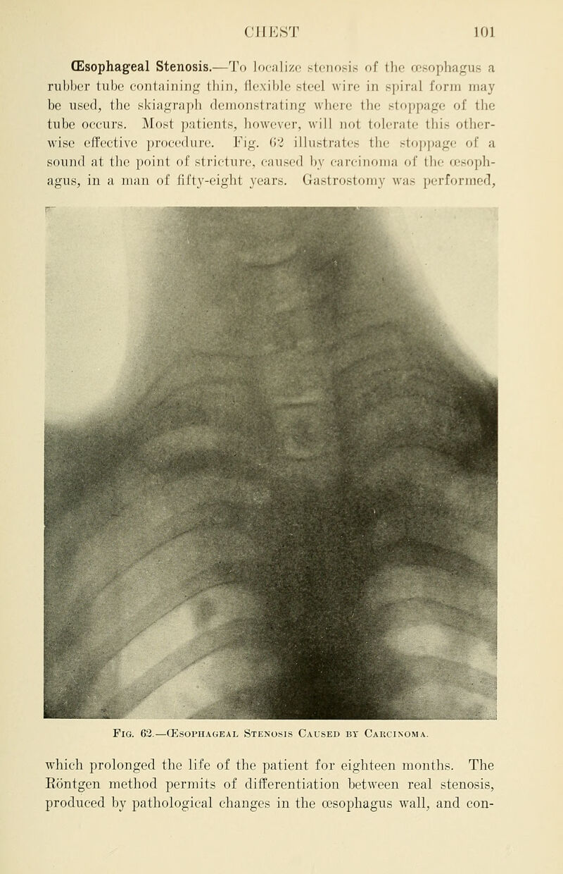 (Esophageal Stenosis.—To Localize stenosis of the oesophagus a rubber tube containing thin, flexible steel wire in spiral form may be used, the skiagraph demonstrating where the stoppage of the tube occurs. Most patients, however, will no! tolerate this other- wise effective procedure. Fig. 62 illustrates the stoppage of a sound at the point of stricture, caused by carcinoma of the 'esoph- agus, in a man of fifty-eight years. Gastrostomy was performed, Fig. 62.—(Esophageal Stenosis Caused by Carcinoma. which prolonged the life of the patient for eighteen months. The Rontgen method permits of differentiation between real stenosis, produced by pathological changes in the oesophagus wall, and con-