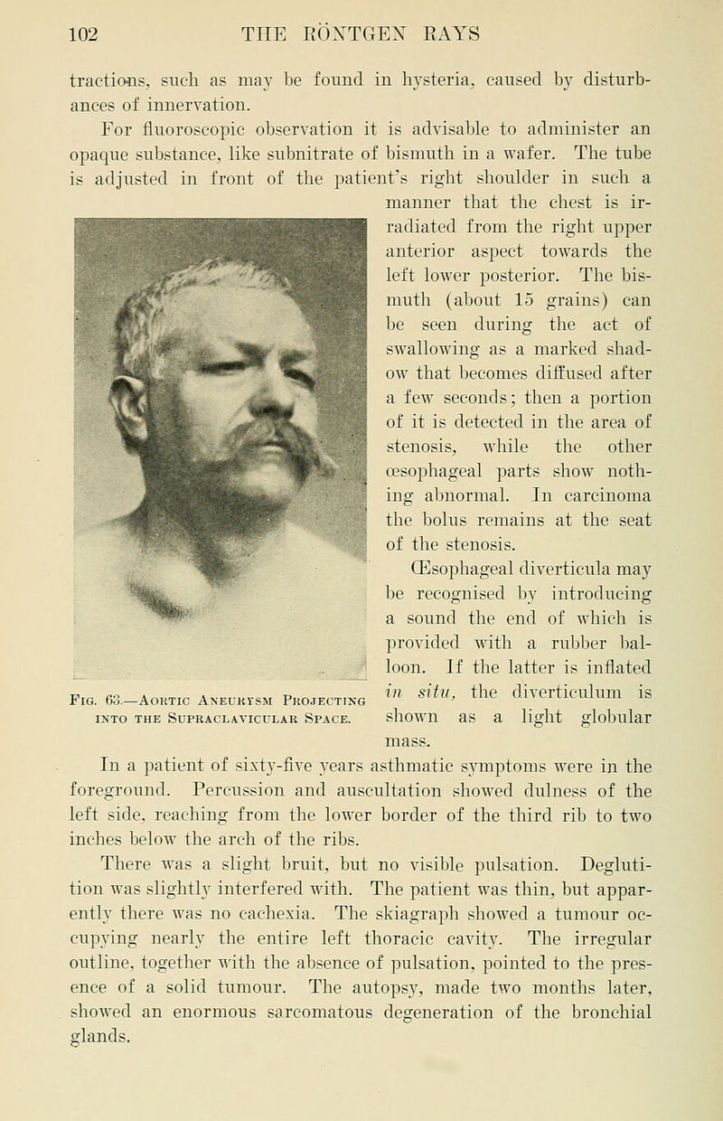tractions, such as may be found in hysteria, caused by disturb- ances of innervation. For fluoroscopic observation it is advisable to administer an opaque substance, like subnitrate of bismuth in a wafer. The tube is adjusted in front of the patient's right shoulder in such a manner that the chest is ir- radiated from the right upper anterior aspect towards the left lower posterior. The bis- muth (about 15 grains) can be seen during the act of swallowing as a marked shad- ow that becomes diffused after a few seconds; then a portion of it is detected in the area of stenosis, while the other oesophageal parts show noth- ing abnormal. In carcinoma the bolus remains at the seat of the stenosis. (Esophageal diverticula may be recognised by introducing a sound the end of which is provided with a rubber bal- loon. If the latter is inflated in situ, the diverticulum is shown as a light globular mass. In a patient of sixty-five years asthmatic symptoms were in the foreground. Percussion and auscultation showed dulness of the left side, reaching from the lower border of the third rib to two inches below the arch of the ribs. There was a slight bruit, but no visible pulsation. Degluti- tion was slightly interfered with. The patient was thin, but appar- ently there was no cachexia. The skiagraph showed a tumour oc- cupying nearly the entire left thoracic cavity. The irregular outline, together with the absence of pulsation, pointed to the pres- ence of a solid tumour. The autopsy, made two months later, showed an enormous sarcomatous degeneration of the bronchial glands. Fig. 63.—Aortic Aneurysm Projecting into the Supraclavicular Space.