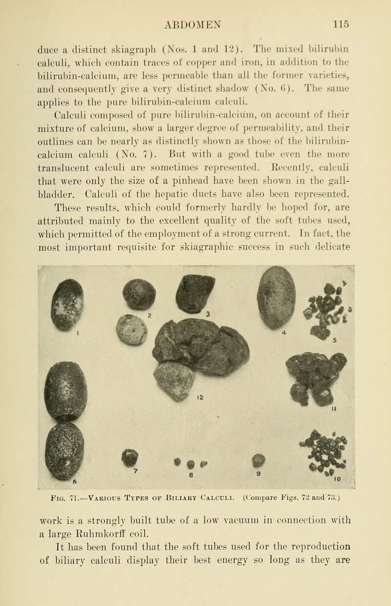 cluce a distinct skiagraph (Nos. 1 and 12). The mixed bilirubin calculi, which contain traces of copper and iron, in addition to the bilirubin-calcium, are less permeable than all the former varieties, and consequently give a very distinct shadow ( No. 6). The same applies to the pure bilirubin-calcium calculi. Calculi composed of pure bilirubin-calcium, on account of their mixture of calcium, show a larger degree of permeability, and their outlines can be nearly as distinctly shown as those of the hiliruhin- calcium calculi (No. 7). But with a good tube even the more translucent calculi are sometimes represented. Recently, calculi that were only the size of a pinhead have been shown in the gall- bladder. Calculi of the hepatic ducts have also been represented. These results, which could formerly hardly be hoped for, are attributed mainly to the excellent quality of the soft tubes used, which permitted of the employment of a strong current. In fact, the most important requisite for skiagraphic success in such delicate Pig. 71.—Various Types of Biliary Calculi. (Compare Figs. 7:2 and 73.) work is a strongly built tube of a low vacuum in connection with a large Ruhmkorff coil. It has been found that the soft tubes used for the reproduction of biliary calculi display their best energy so long as they are