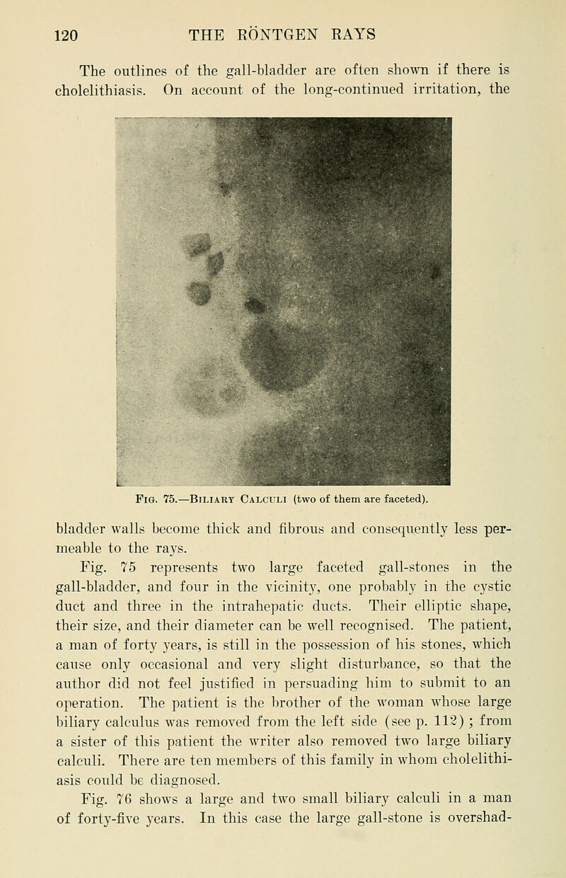 The outlines of the gall-bladder are often shown if there is cholelithiasis. On account of the long-continued irritation, the Fig. 75.—Biliary Calculi (two of them are faceted). bladder walls become thick and fibrous and consequently less per- meable to the rays. Fig. 75 represents two large faceted gall-stones in the gall-bladder, and four in the vicinity, one probably in the cystic duct and three in the intrahepatic ducts. Their elliptic shape, their size, and their diameter can be well recognised. The patient, a man of forty years, is still in the possession of his stones, which cause only occasional and very slight disturbance, so that the author did not feel justified in persuading him to submit to an operation. The patient is the brother of the woman whose large biliary calculus was removed from the left side (see p. 112) ; from a sister of this patient the writer also removed two large biliary calculi. There are ten members of this family in whom cholelithi- asis could be diagnosed. Fig. 76 shows a large and two small biliary calculi in a man of forty-five years. In this case the large gall-stone is overshad-