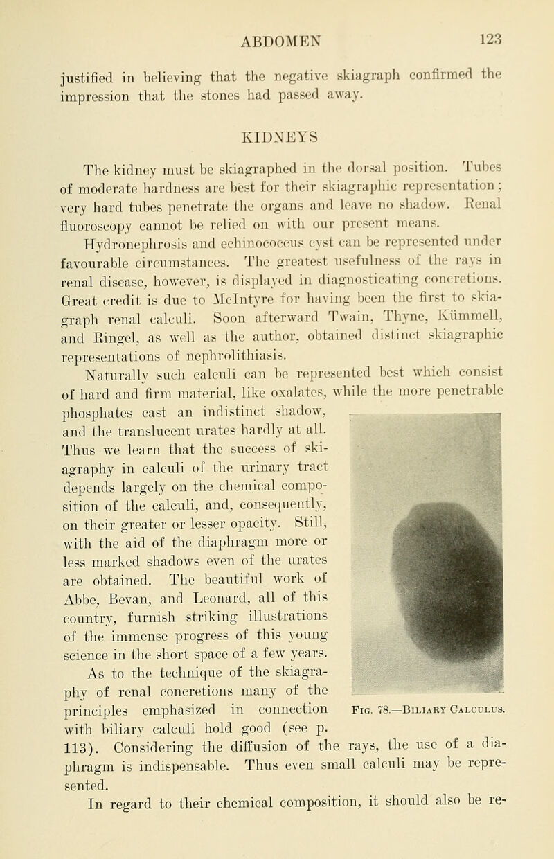 justified in believing that the negative skiagraph confirmed the impression that the stones had passed away. KIDNEYS The kidney must be skiagraphed in the dorsal position. Tubes of moderate hardness are best for their skiagraphy representation; very hard tubes penetrate the organs and leave no shadow. Renal fluoroscopy cannot be relied on with our present means. Hydronephrosis and echinococeus cyst can be represented under favourable circumstances. The greatest usefulness of the rays in renal disease, however, is displayed in diagnosticating concretions. Great credit is due to Mclntyre for having been the first to skia- graph renal calculi. Soon afterward Twain, Thyne, Kummell, and Ringel, as well as the author, obtained distinct skiagraphic representations of nephrolithiasis. Naturally such calculi can be represented best which consist of hard and firm material, like oxalates, while the more penetrable phosphates cast an indistinct shadow, and the translucent urates hardly at all. Thus we learn that the success of ski- agraphy in calculi of the urinary tract depends largely on the chemical compo- sition of the calculi, and, consequently, on their greater or lesser opacity. Still, with the aid of the diaphragm more or less marked shadows even of the urates are obtained. The beautiful work of Abbe, Bevan, and Leonard, all of this country, furnish striking illustrations of the immense progress of this young science in the short space of a few years. As to the technique of the skiagra- phy of renal concretions many of the principles emphasized in connection with biliary calculi hold good (see p. 113). Considering the diffusion of the rays, the use of a dia- phragm is indispensable. Thus even small calculi may be repre- sented. In regard to their chemical composition, it should also be re- Fig. 78.—Biliary Calculus.