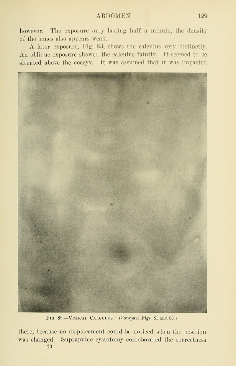 ABDOMEN 120 however. The exposure only lasting half a minute, the density of the bones also appears weak. A later exposure, Fig. 83, shows the calculus very distinctly. An oblique exposure showed the calculus faintly. It seemed to be situated above the coccyx. It was assumed that it was impacted Fig. 82.—Vesical Calculus. (Compare Figs. 81 and 83.) there, because no displacement could be noticed when the position was changed. Suprapubic cystotomy corroborated the correctness 10