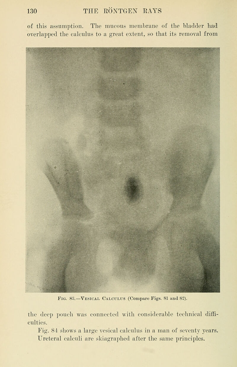 of this assumption. The mucous membrane of the bladder had overlapped the calculus to a great extent, so that its removal from Fig. 83.—Vesical Calculus (Compare Figs. 81 and 82). the deep pouch was connected with considerable technical diffi- culties. Fig. 84 shows a large vesical calculus in a man of seventy years. Ureteral calculi are skiagraphed after the same principles.