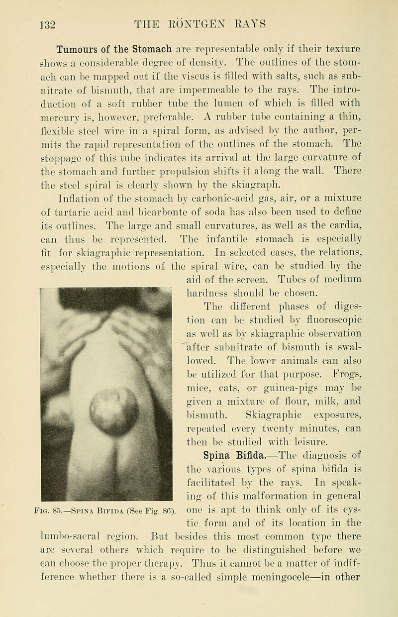 Tumours of the Stomach are representable only if their texture shows a considerable degree of density. The outlines of the stom- ach can be mapped out if the viscus is filled with salts, such as sub- nitrate of bismuth, that are impermeable to the rays. The intro- duction of a soft rubber tube the lumen of which is filled with mercury is, however, preferable. A rubber tube containing a thin, flexible steel wire in a spiral form, as advised by the author, per- mits the rapid representation of the outlines of the stomach. The stoppage of this tube indicates its arrival at the large curvature of the stomach and further propulsion shifts it along the wall. There the steel spiral is clearly shown by the skiagraph. Inflation of the stomach by carbonic-acid gas, air, or a mixture of tartaric acid and bicarbonte of soda has also been used to define its outlines. The large and small curvatures, as well as the cardia, can thus be represented. The infantile stomach is especially fit for skiagraphic representation. In selected cases, the relations, especially the motions of the spiral wire, can be studied by the aid of the screen. Tubes of medium hardness should be chosen. The different phases of diges- tion can be studied by fluoroscopic as well as by skiagraphic observation after subnitrate of bismuth is swal- lowed. The lower animals can also be utilized for that purpose. Frogs, mice, cats, or guinea-pigs may be given a mixture of flour, milk, and bismuth. Skiagraphic exposures, repeated every twenty minutes, can then be studied with leisure. Spina Bifida.—The diagnosis of the various types of spina bifida is facilitated by the rays. In speak- ing of this malformation in general one is apt to think only of its cys- tic form and of its location in the lumbo-sacral region. But besides this most common type there are several others which require to be distinguished before we can choose the proper therapy. Thus it cannot be a matter of indif- ference whether there is a so-called simple meningocele—in other Fig. 85.—Spina Bifida (See Fig. 86).